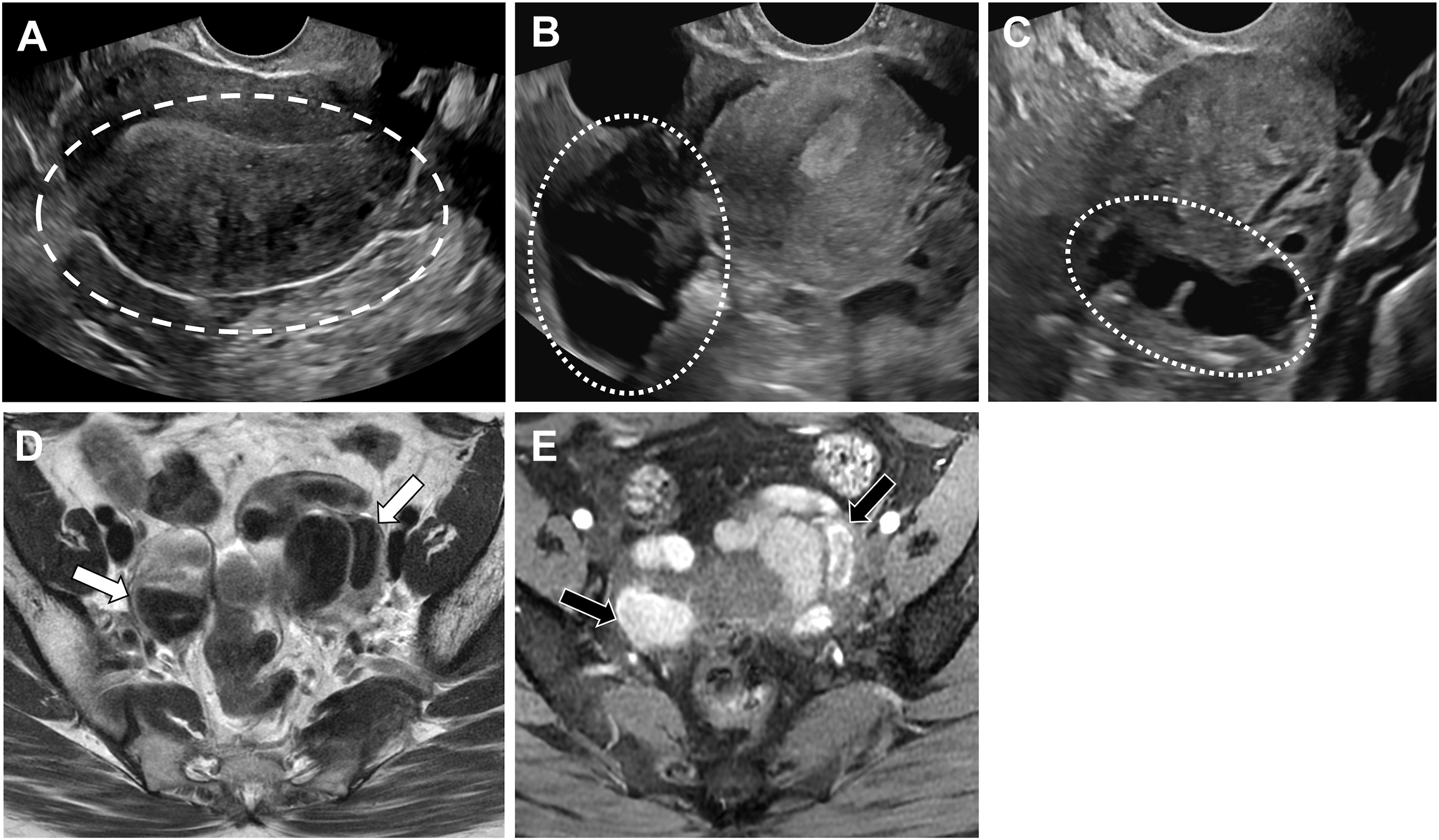 Five panels show adenomyosis with heterogeneous posterior myometrium and Venetian blind appearance on ultrasound, and bilateral hydro- and hematosalpinges on ultrasound and M R I.