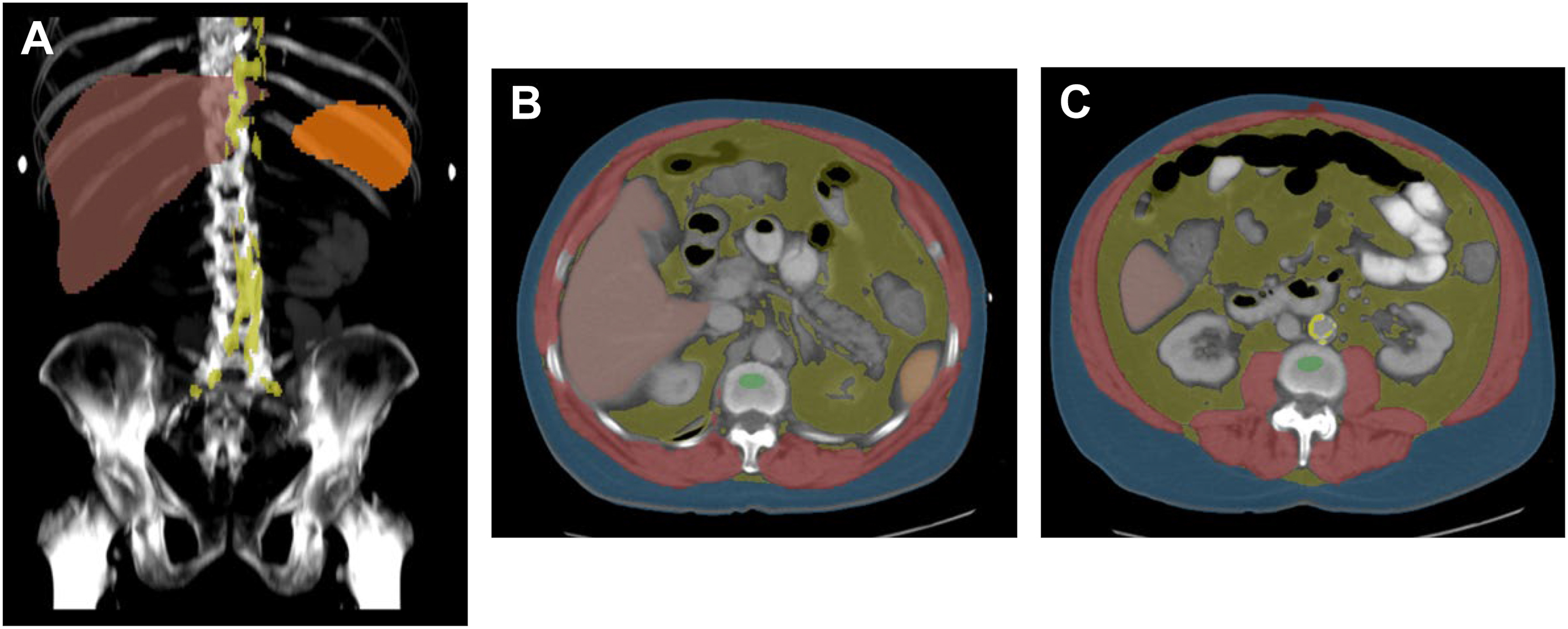 Three panels show abdominal aortic calcification with automated color overlays on coronal and axial C T images in a 65-year-old man who presented to the emergency department with abdominal pain.