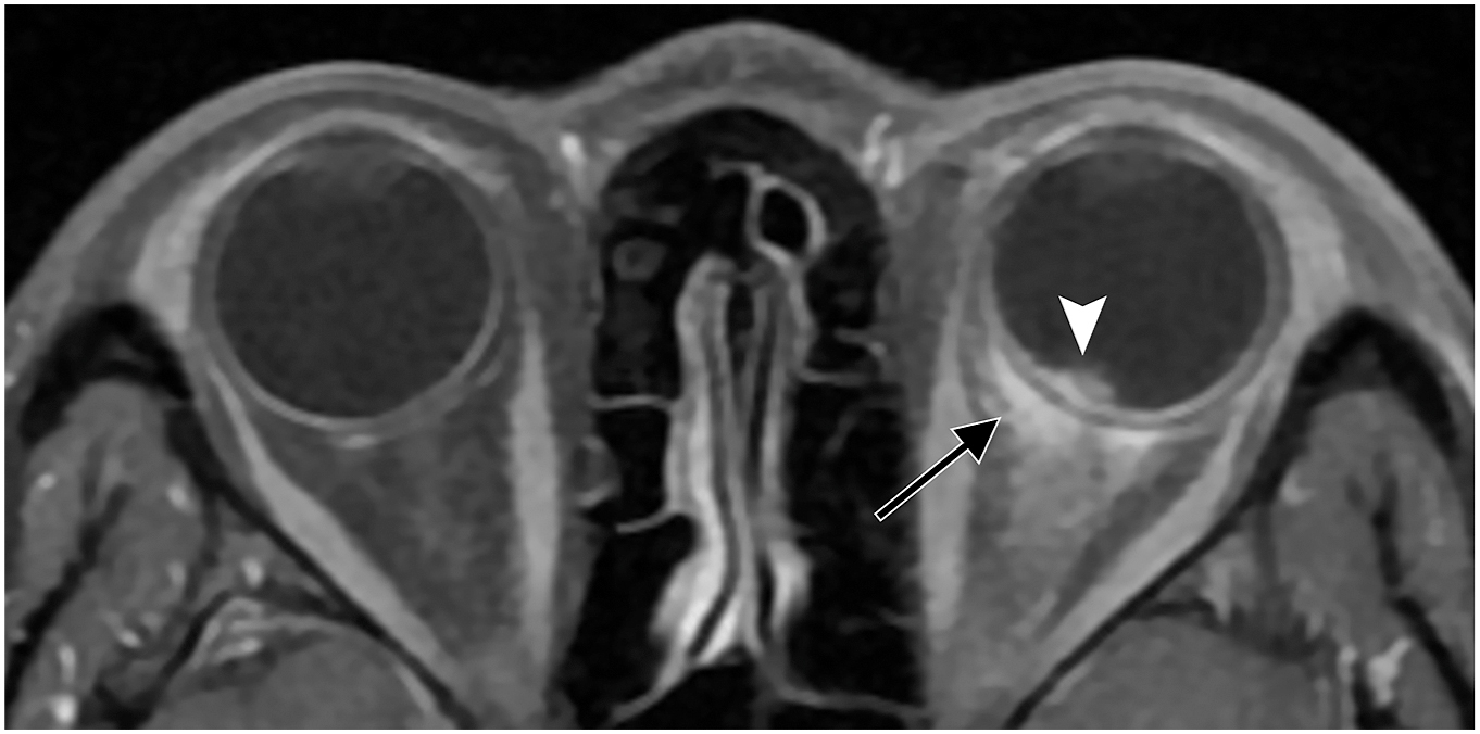 A M R I shows left posterior scleritis with nodular thickening (arrow) mimicking a choroidal tumor (arrowhead).
