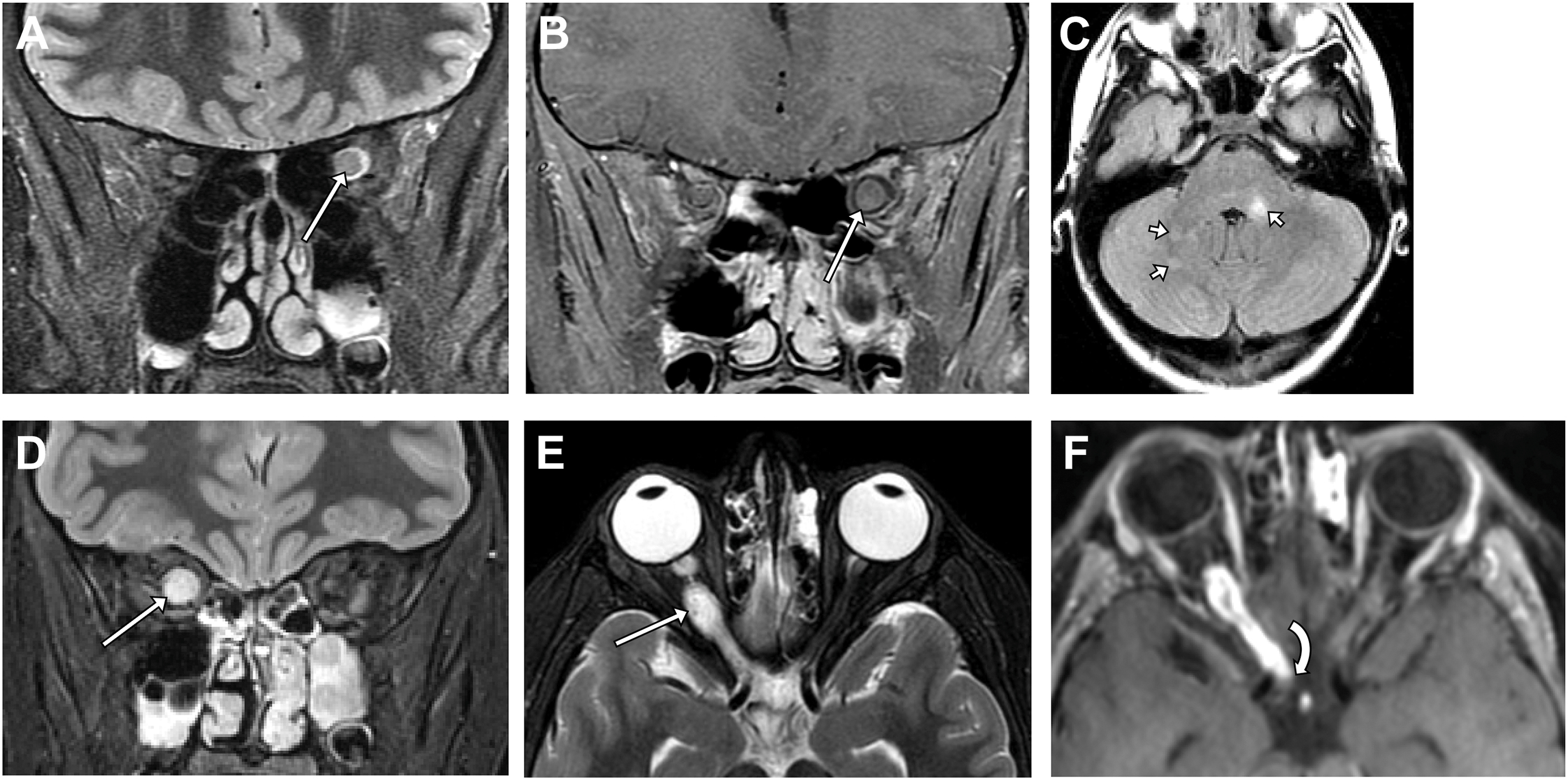 A six-panel magnetic resonance scans show a syndromic optic pathway glioma in a neurofibromatosis patient alongside a sporadic, enhancing midline pilocytic astrocytoma.