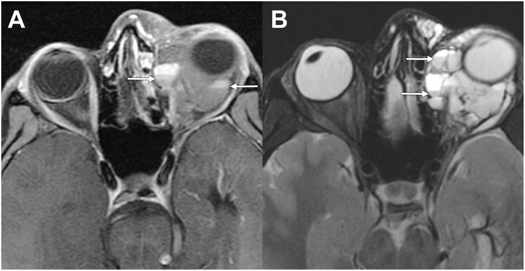 A two-part magnetic resonance imaging scan shows a lymphatic malformation known as a lymphangioma in the left orbit, with arrows pointing to fluid levels in an infiltrative mass.