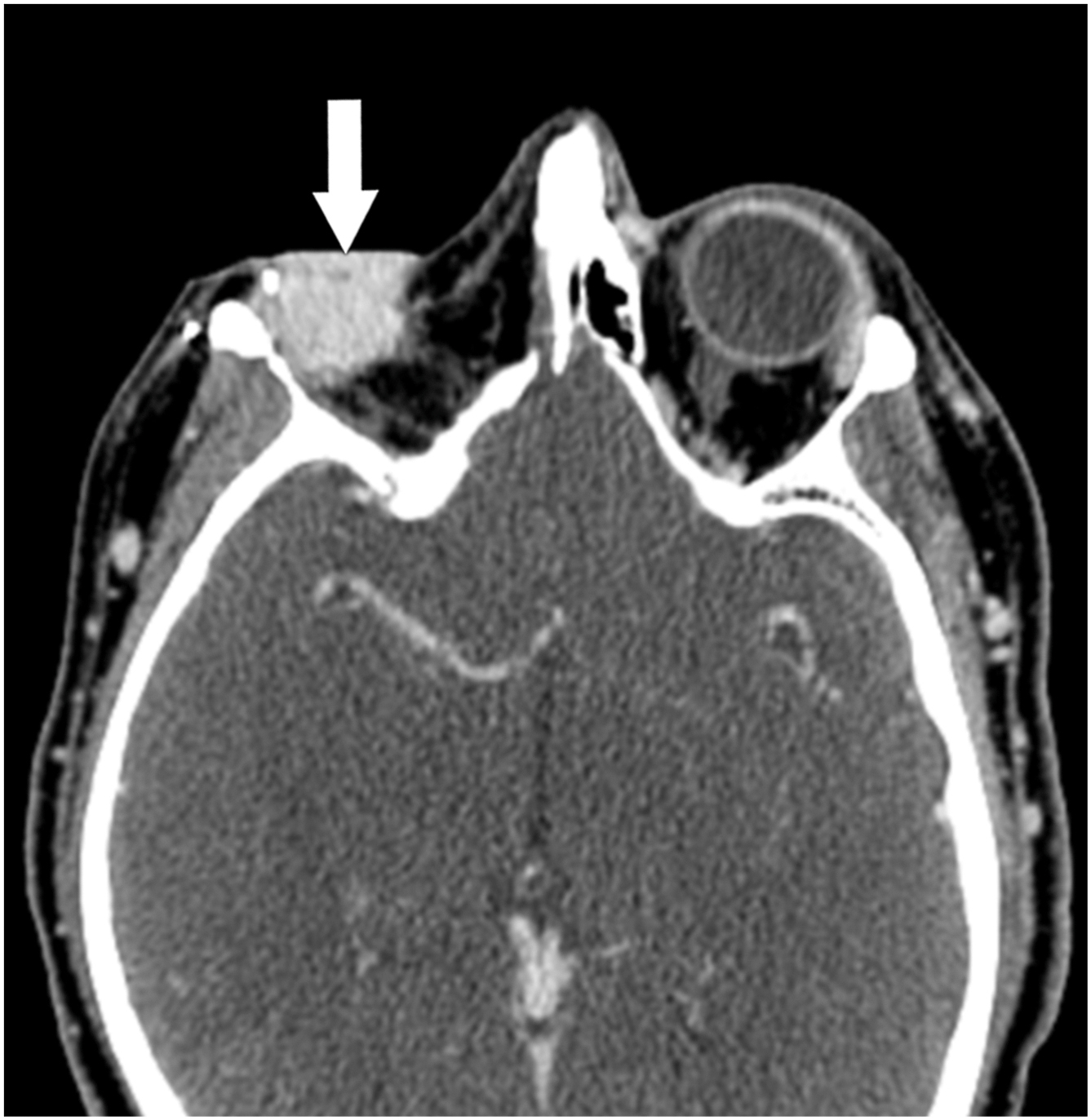 A computed tomography scan shows a hyperdense hemorrhage within a reconstructive flap in the right orbit of a male patient following an exenteration for squamous cell carcinoma.