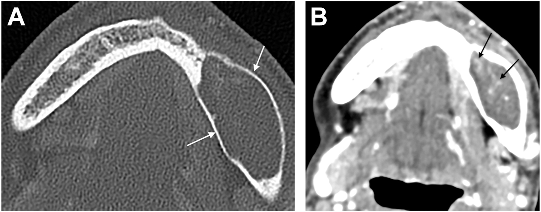 Two computed tomography scans show a mandibular cyst with internal soft tissue mass demonstrating patchy enhancement and irregular morphology.