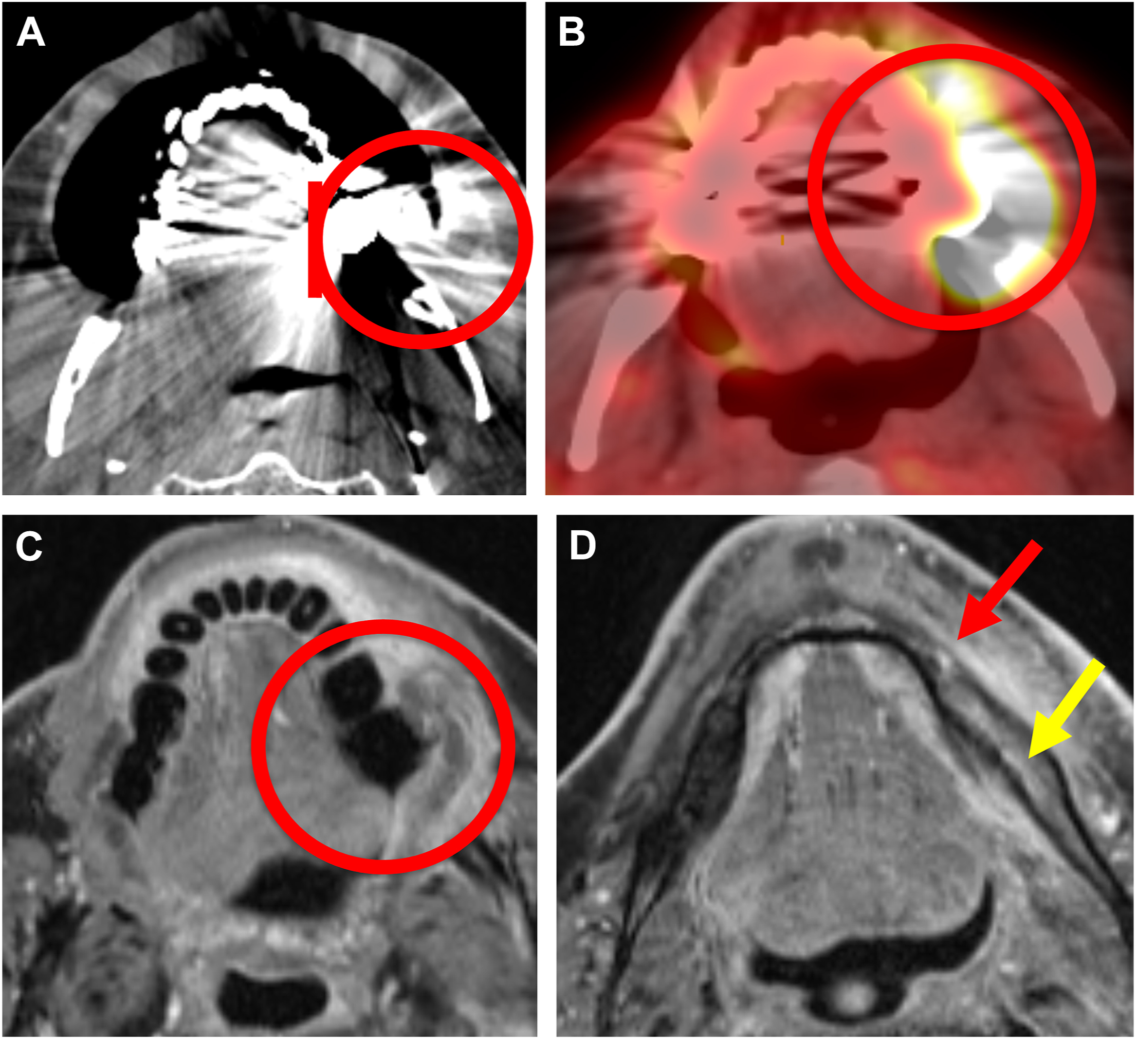 Four axial contrast C T and T 2 M R I scans depict a large right floor of mouth and tongue S C C with matted level two adenopathy, suggesting extracapsular nodal extension.