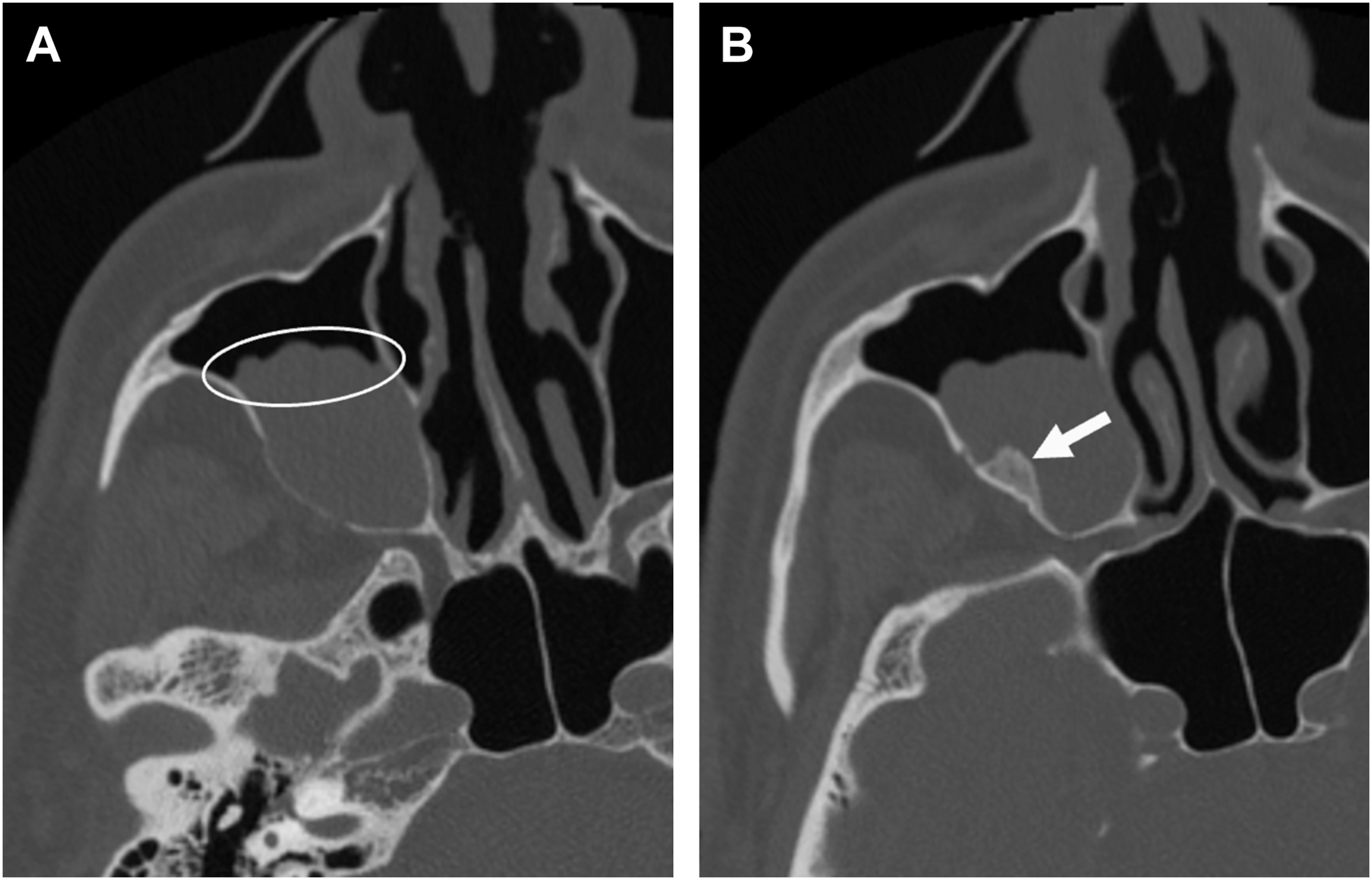 An axial C T scan pair depicts sinus abnormality with the left panel highlights a round lesion in maxillary sinus and the right panel depicts an arrow pointed to bony wall erosion.