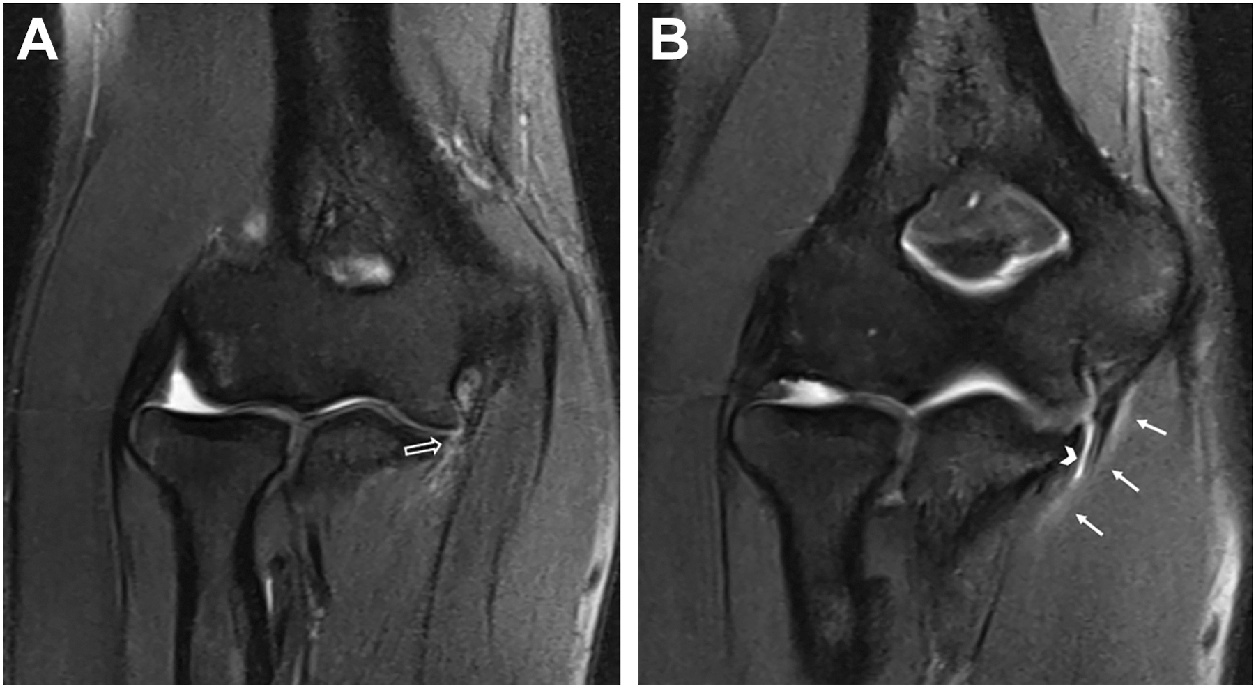 An M R I scan shows two coronal views of the elbow joint with arrows and arrowheads marking ligament and fluid changes.
