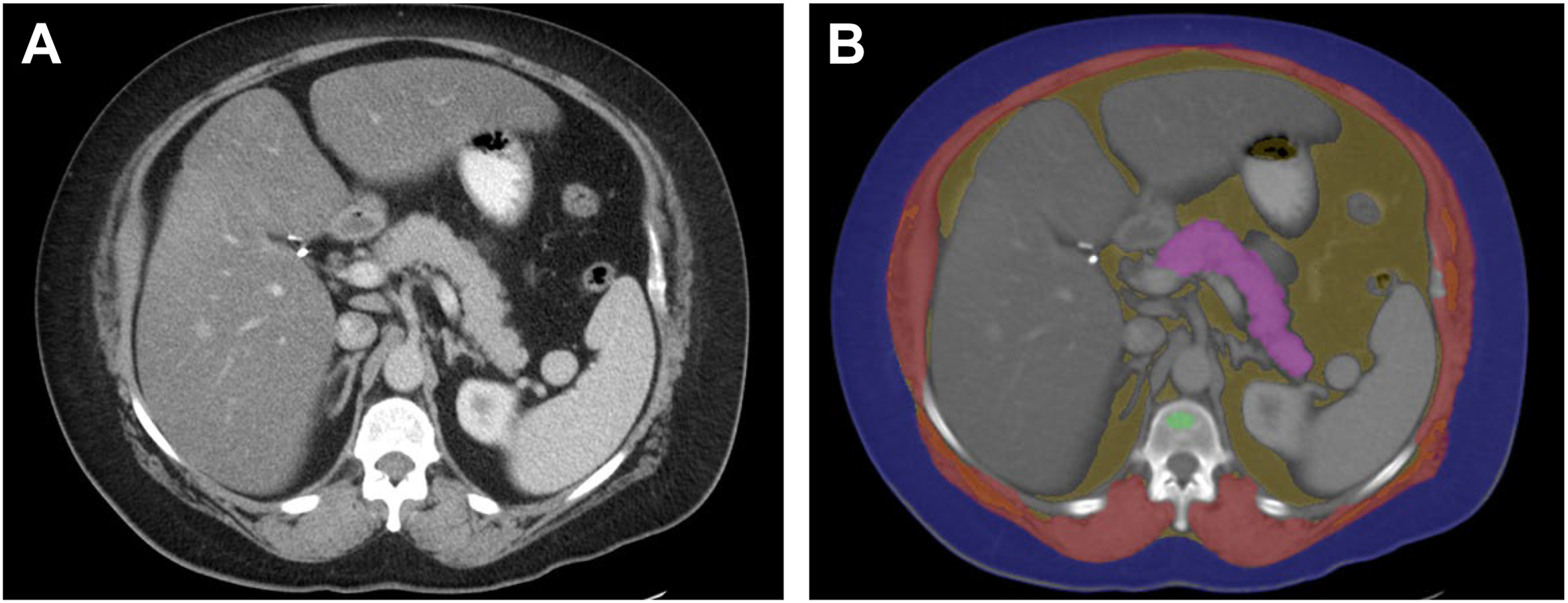 Two panels show an axial C T scan of the upper abdomen alongside a color-coded A I segmentation overlay identifying the pancreas, muscle, bone, and different types of fat.