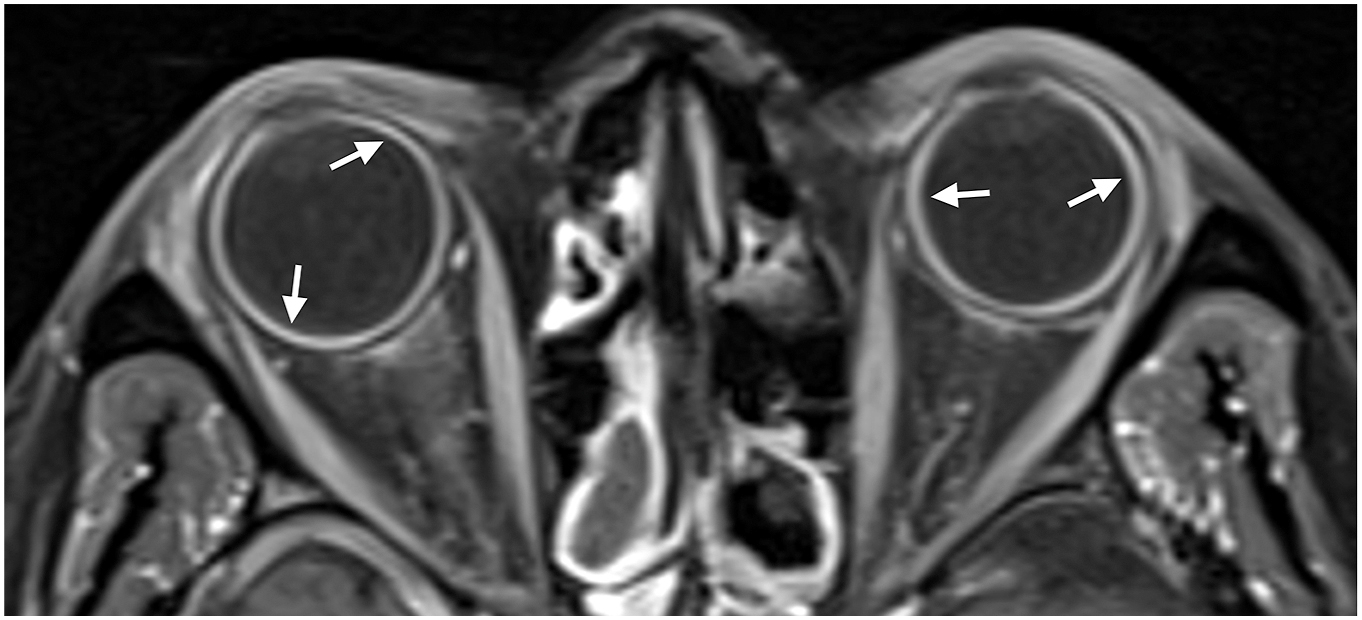 A M R I scan shows bilateral uveal thickening with diffuse enhancement in a patient with Behcet’s disease, consistent with panuveitis (arrows).