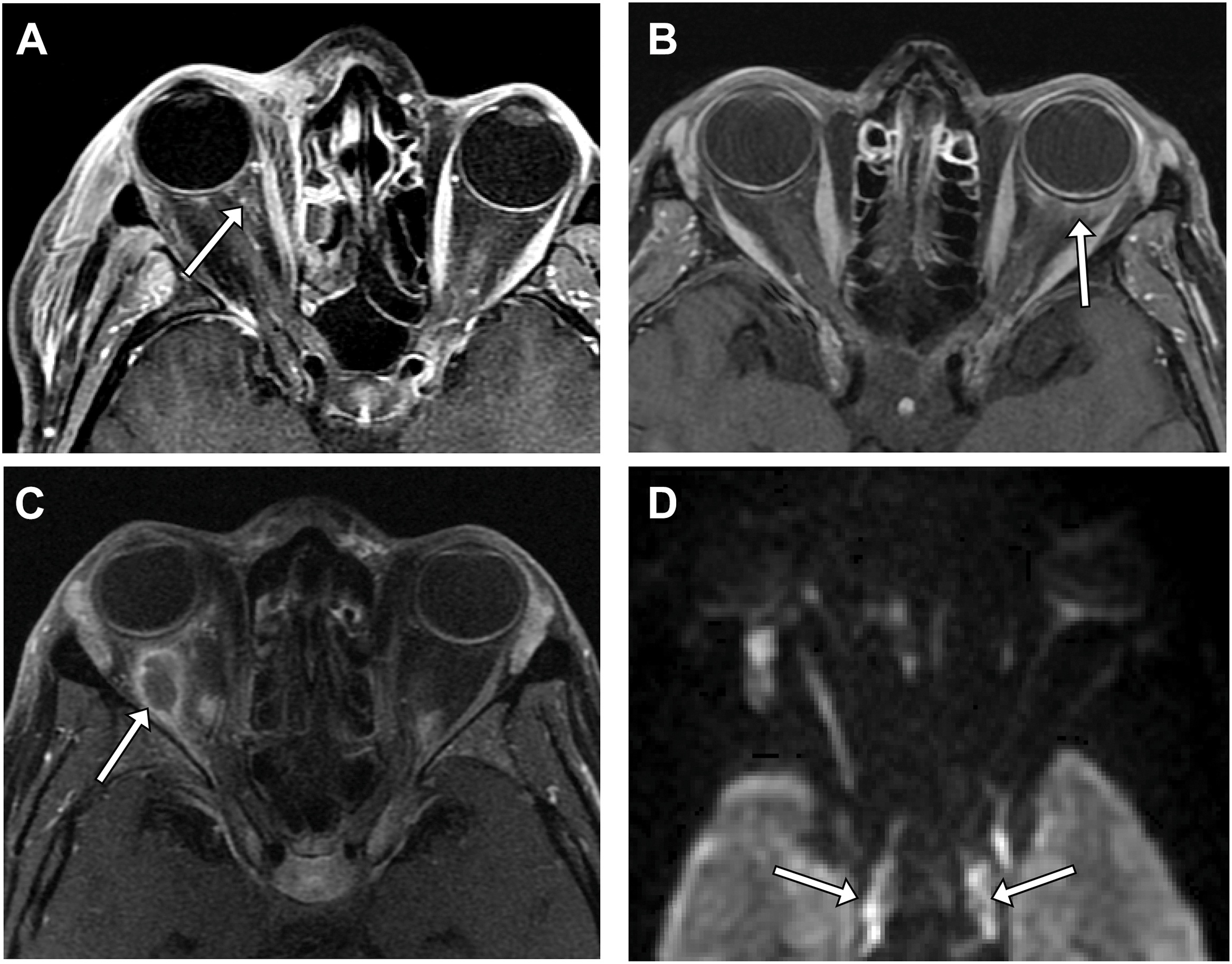 A four-panel axial view radiological scan of the eyes shows the spectrum of intraconal infections, including cellulitis, scleritis, and abscesses.