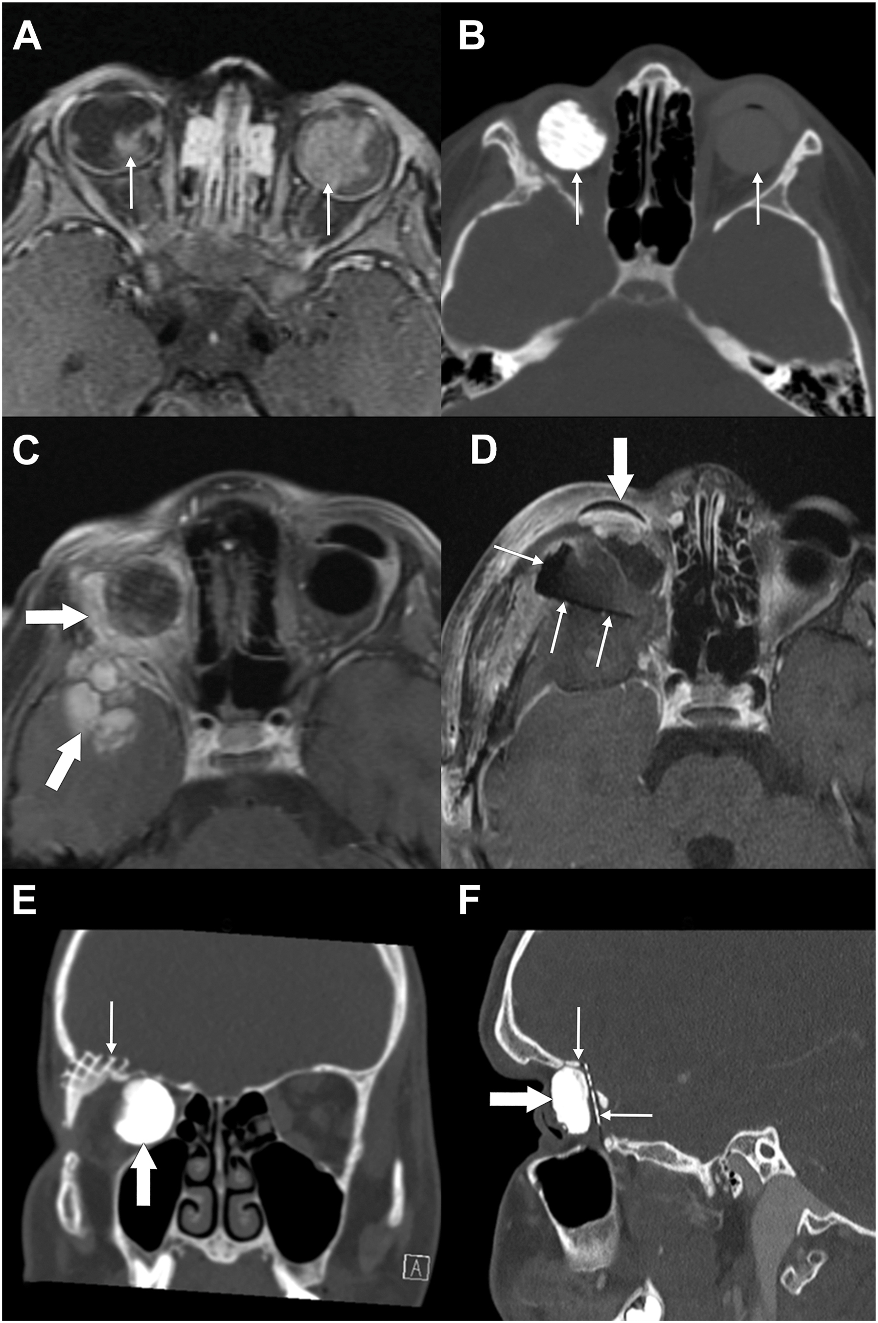A set of six panels with magnetic resonance imaging and computed tomography scans tracks bilateral retinoblastoma recurrence and titanium mesh reconstruction in a pediatric patient.