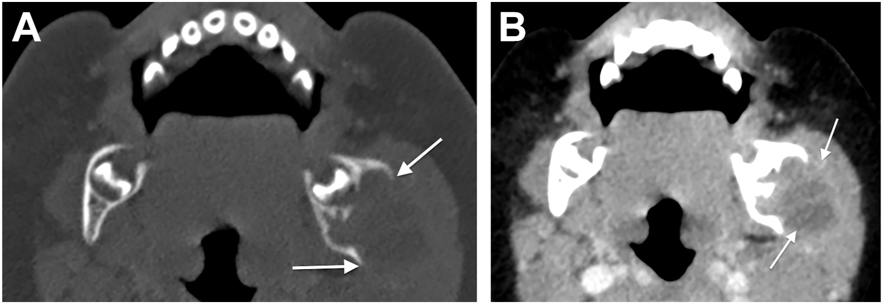 Two computed tomography scans show a mixed lesion in the left mandible extending into the masseter muscle in a child with Langerhans cell histiocytosis.