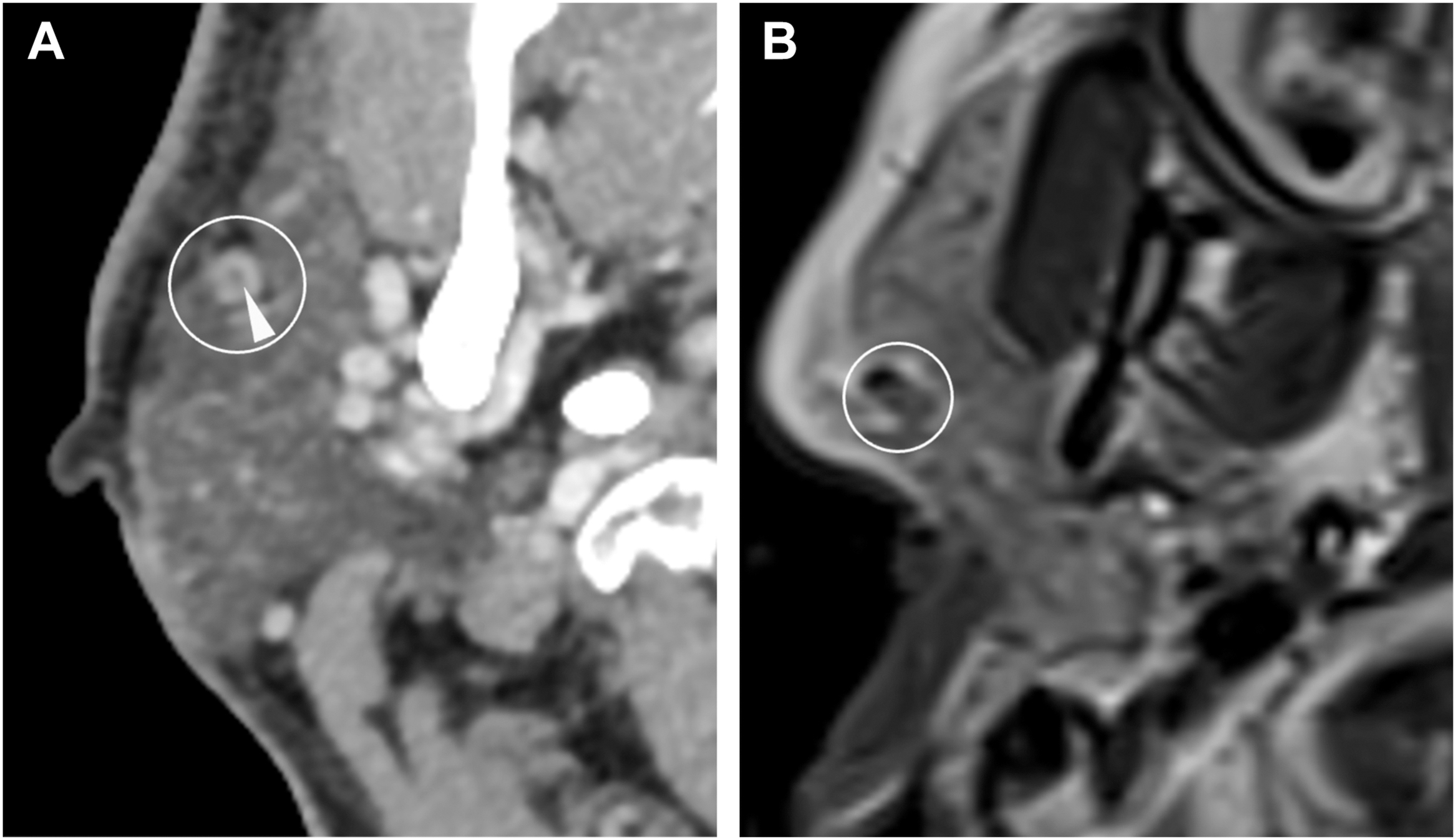 An axial C T and M R I scan pair depicts a circled round lesion in the anterior cheek region near the nasal cavity suggests abnormality or pathology involves soft tissue structures.
