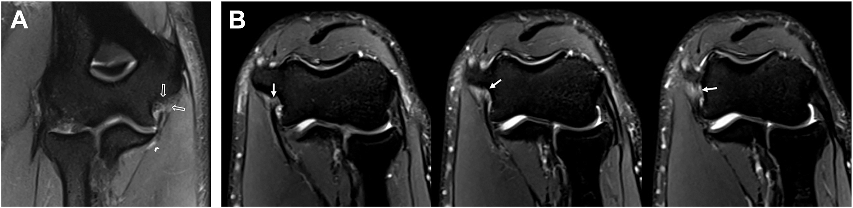 Two M R I panels show a coronal view of the elbow joint with open arrows and an arrowhead marking ligament and signal changes, and three sequential views with solid arrows marking the ligament.