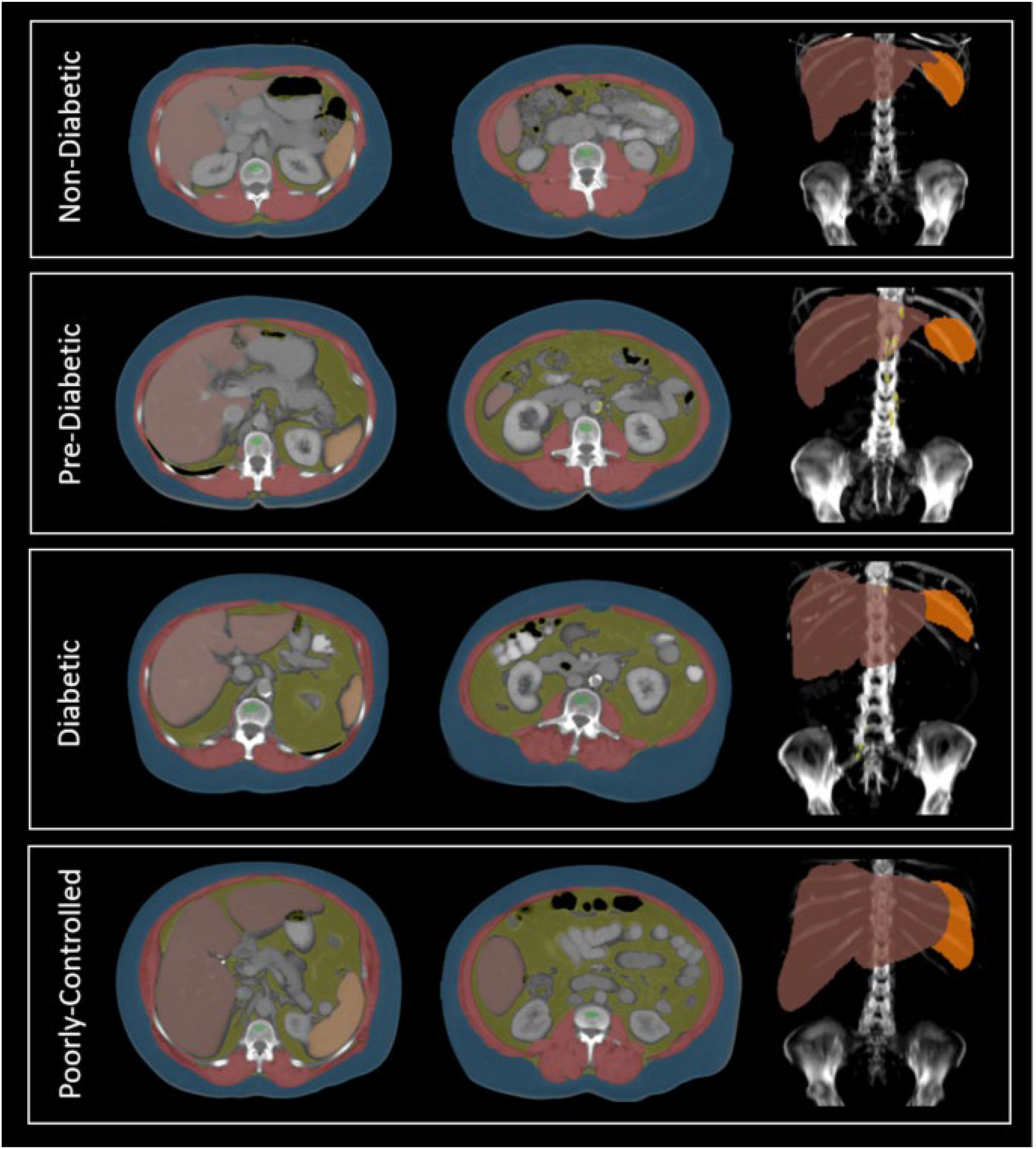 A multi-panel grid shows axial and coronal C T scans with color-coded body composition analysis for non-diabetic, pre-diabetic, diabetic, and poorly controlled diabetic patients.