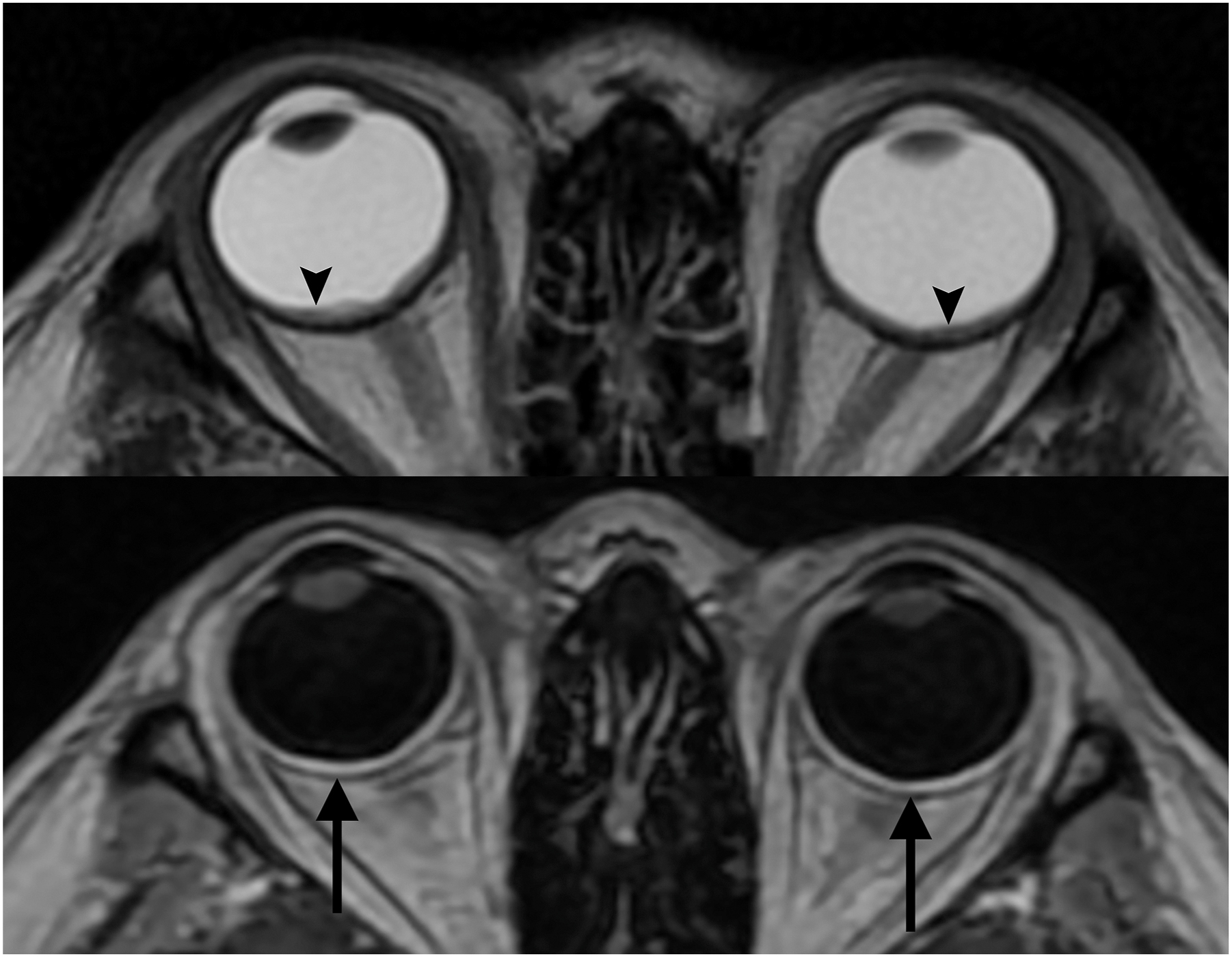 Two M R I scans show bilateral uveal thickening with enhancement and subretinal fluid in Vogt-Koyanagi-Harada (VKH) disease.