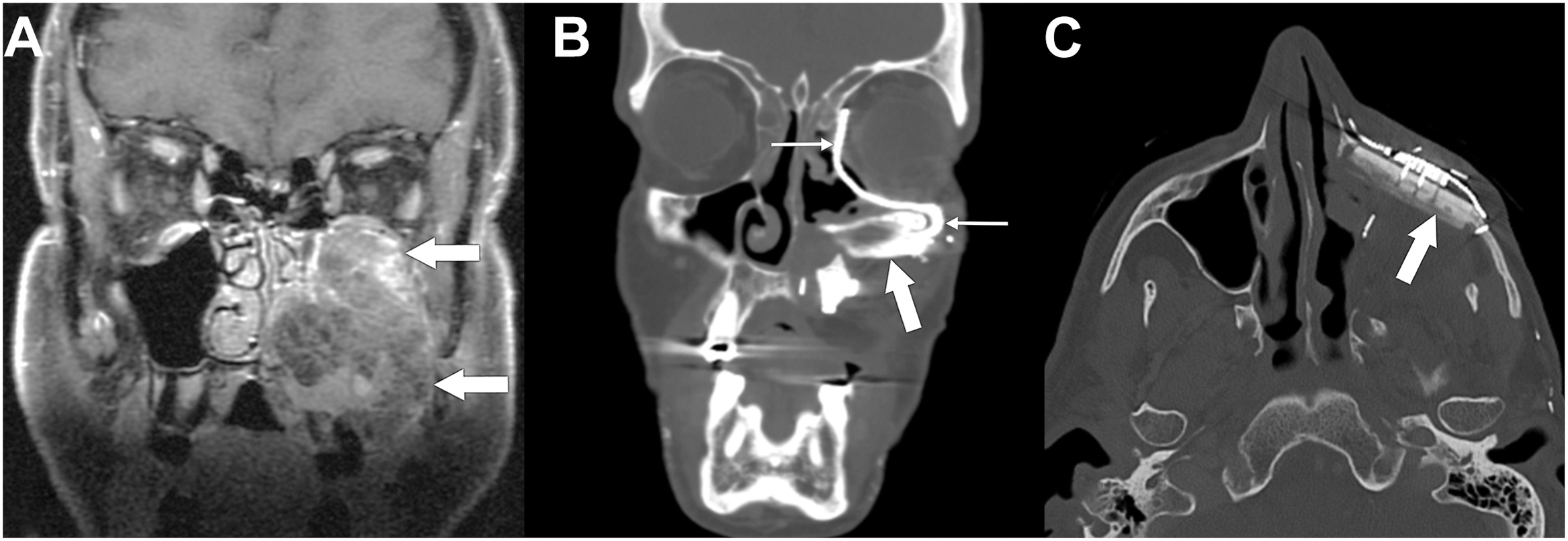 A set of three radiological scans with magnetic resonance imaging and computed tomography shows a left maxillary sinus tumor and subsequent orbital reconstruction with a bone flap and plate.
