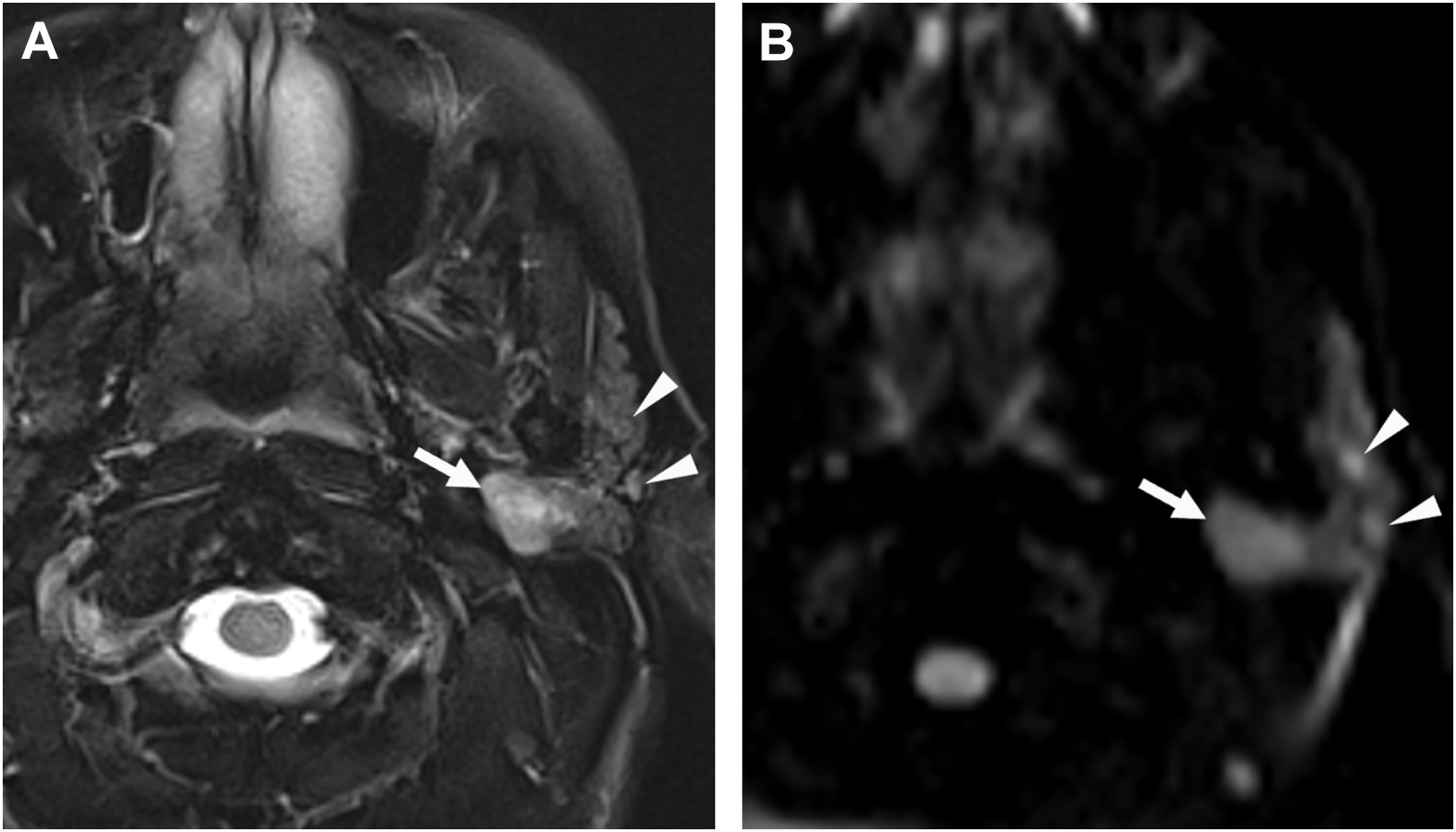 An axial M R I scan pair displays a mass in the left parotid region, indicated by arrows and arrowheads, highlighting a possible abnormal lesion involving adjacent soft tissue structures.