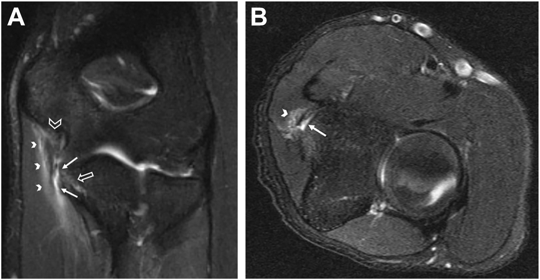 Two M R I scans show coronal and axial views of the elbow joint with arrows and arrowheads marking ligament, fluid, and soft tissue changes.