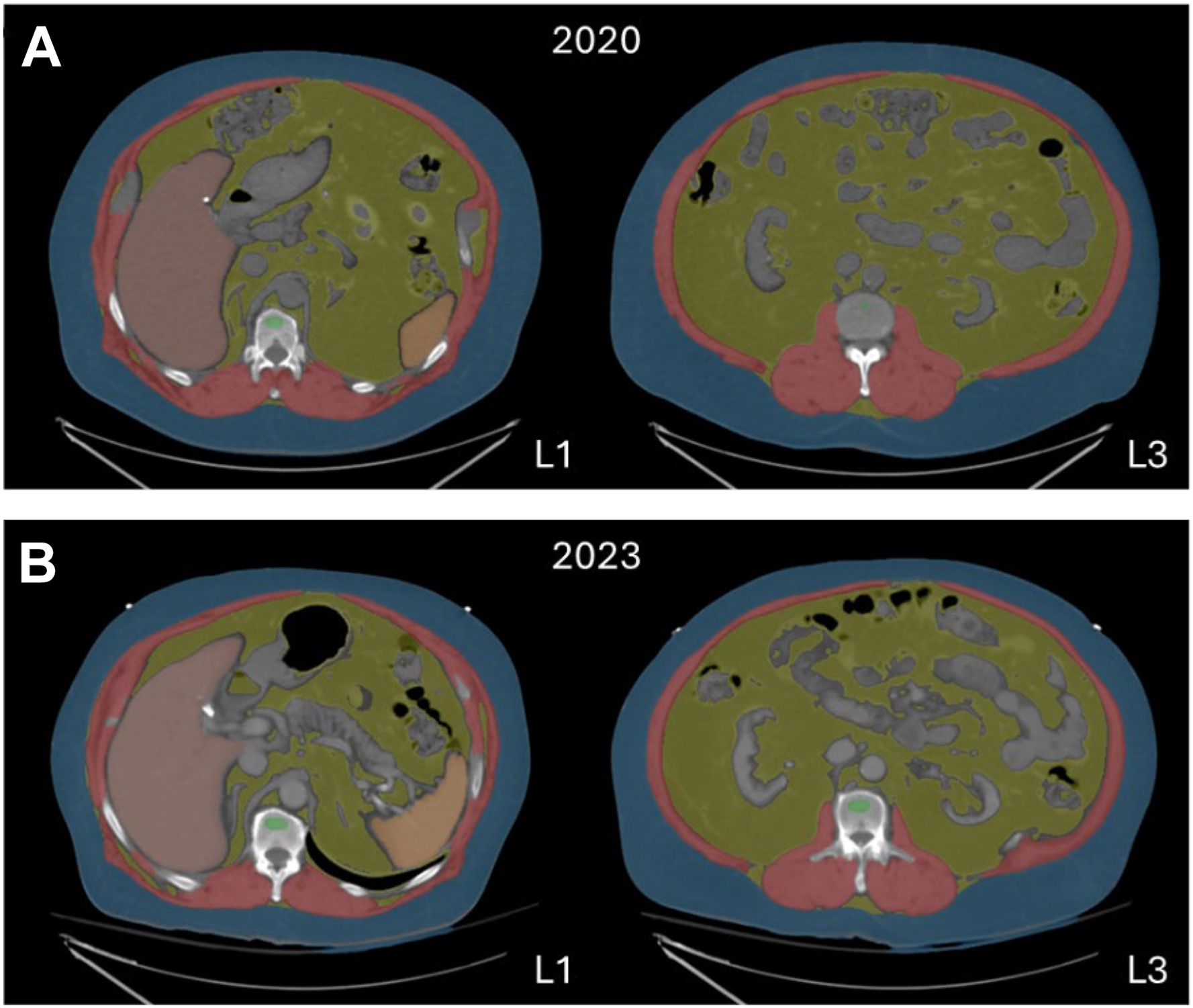 A before-and-after axial C T comparison shows reduced visceral fat and muscle area after G L P-1 receptor agonist treatment with automated color overlay segmentation.