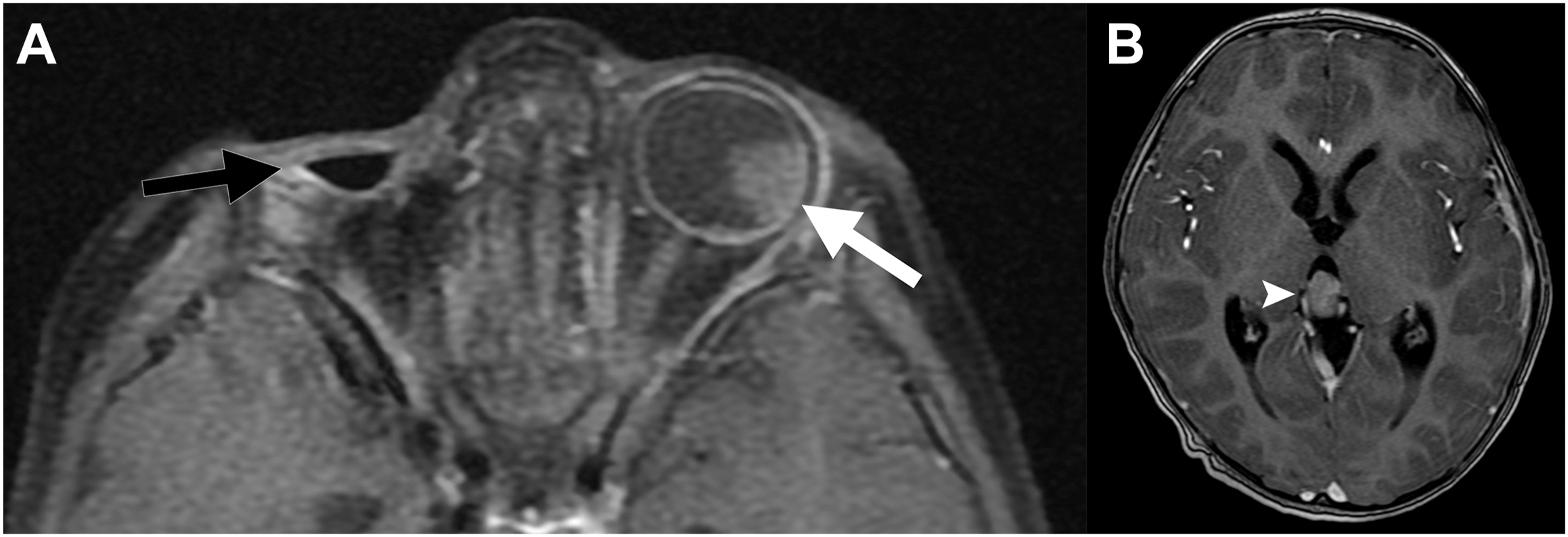 Two M R I shows trilateral retinoblastoma with left globe tumor, prior right eye enucleation, and an enhancing pineal mass.