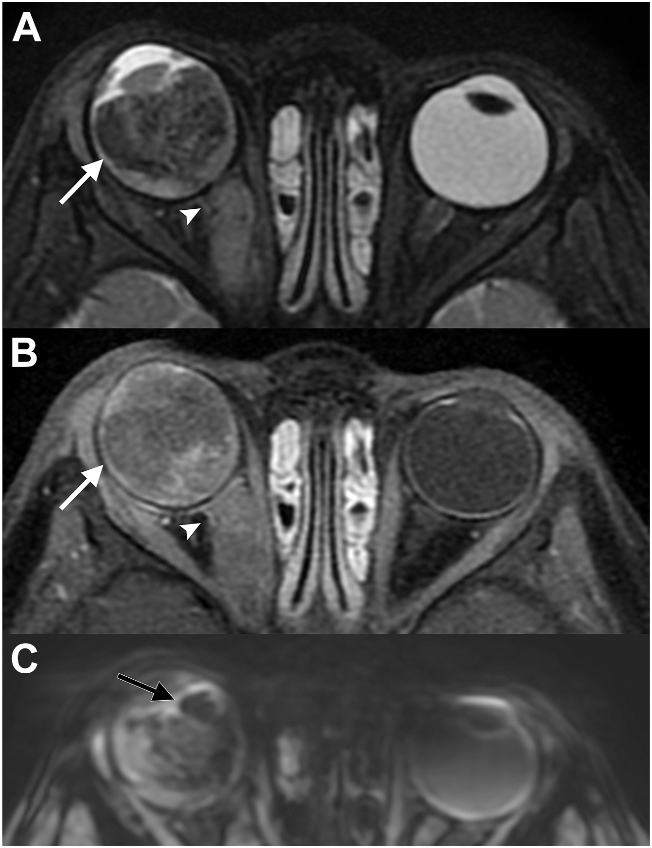Three M R I scans show right retinoblastoma with heterogeneous enhancement, intralesional calcification, and optic nerve invasion.