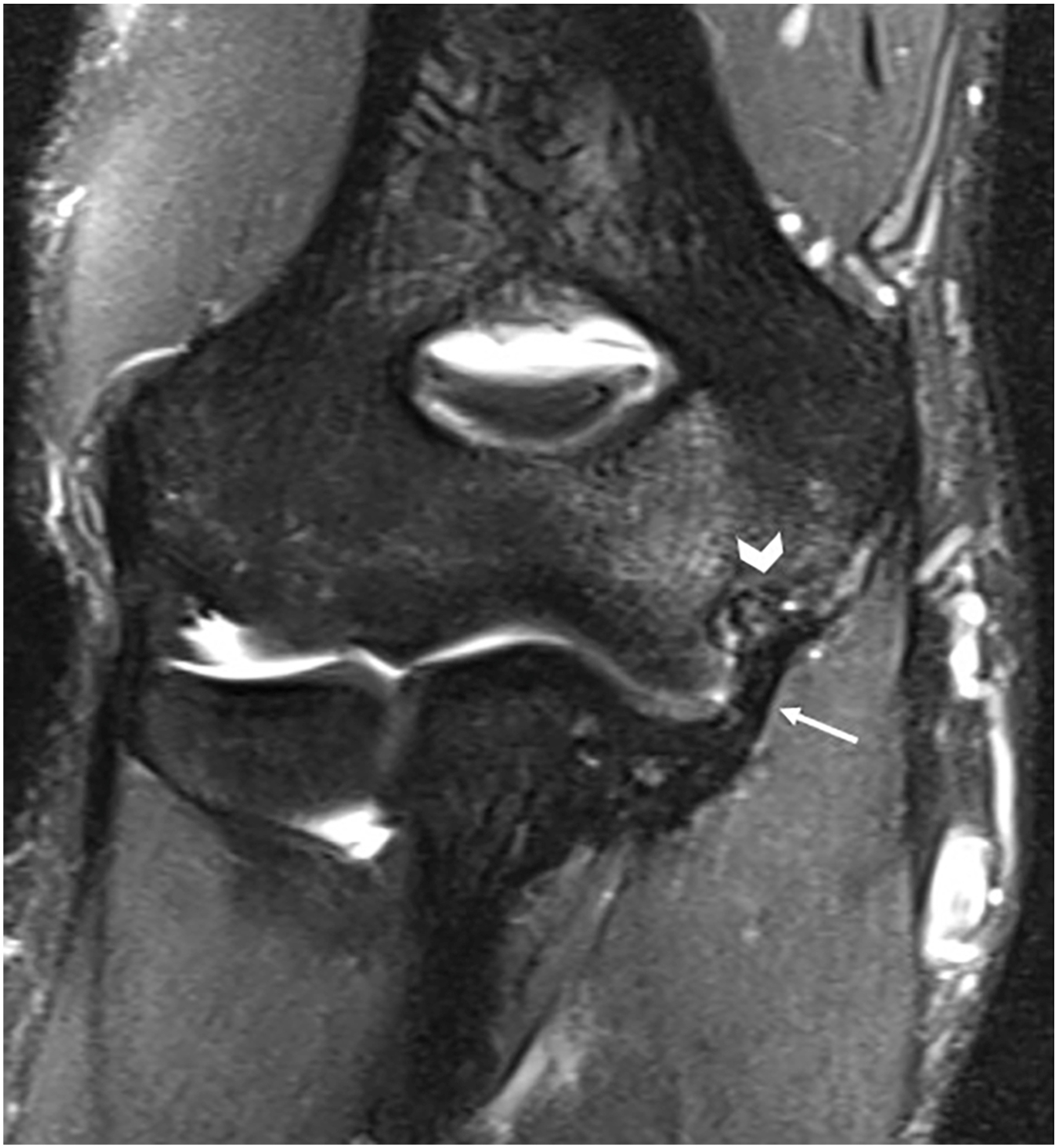 An M R I scan shows a coronal view of the elbow joint with an arrow pointing to the graft fibers and an arrowhead marking signal in the proximal graft.