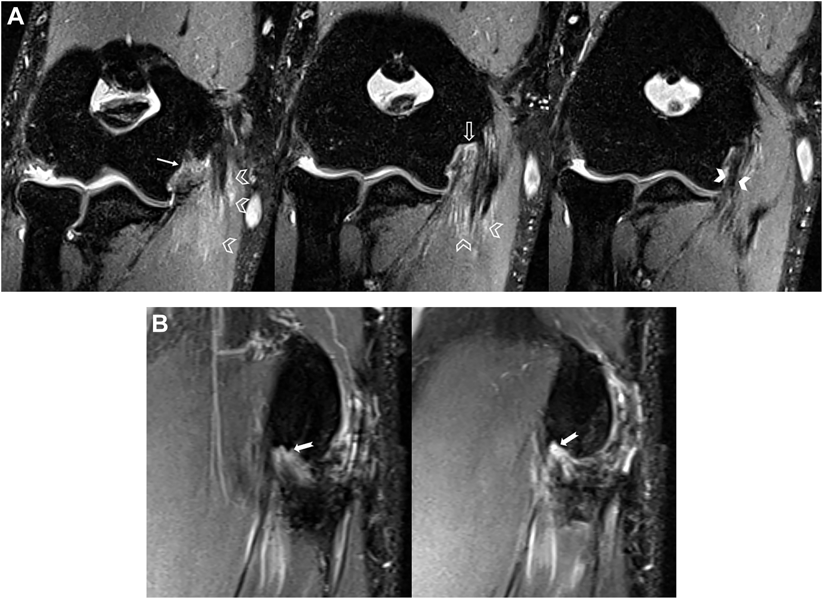Two M R I panels show long axis and sagittal views of the elbow joint with arrows and arrowheads marking graft fibers and soft tissue changes.