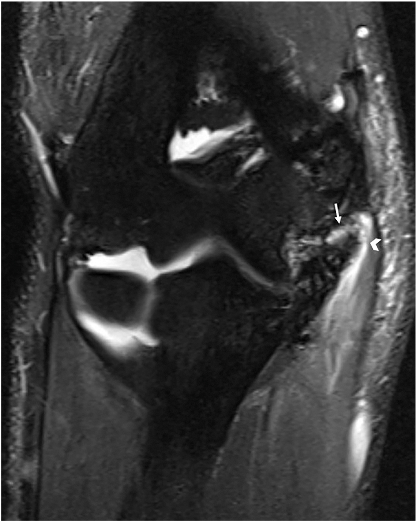 An M R I scan shows a coronal view of the elbow joint with an arrow pointing to the graft and an arrowhead marking changes in surrounding tissue.