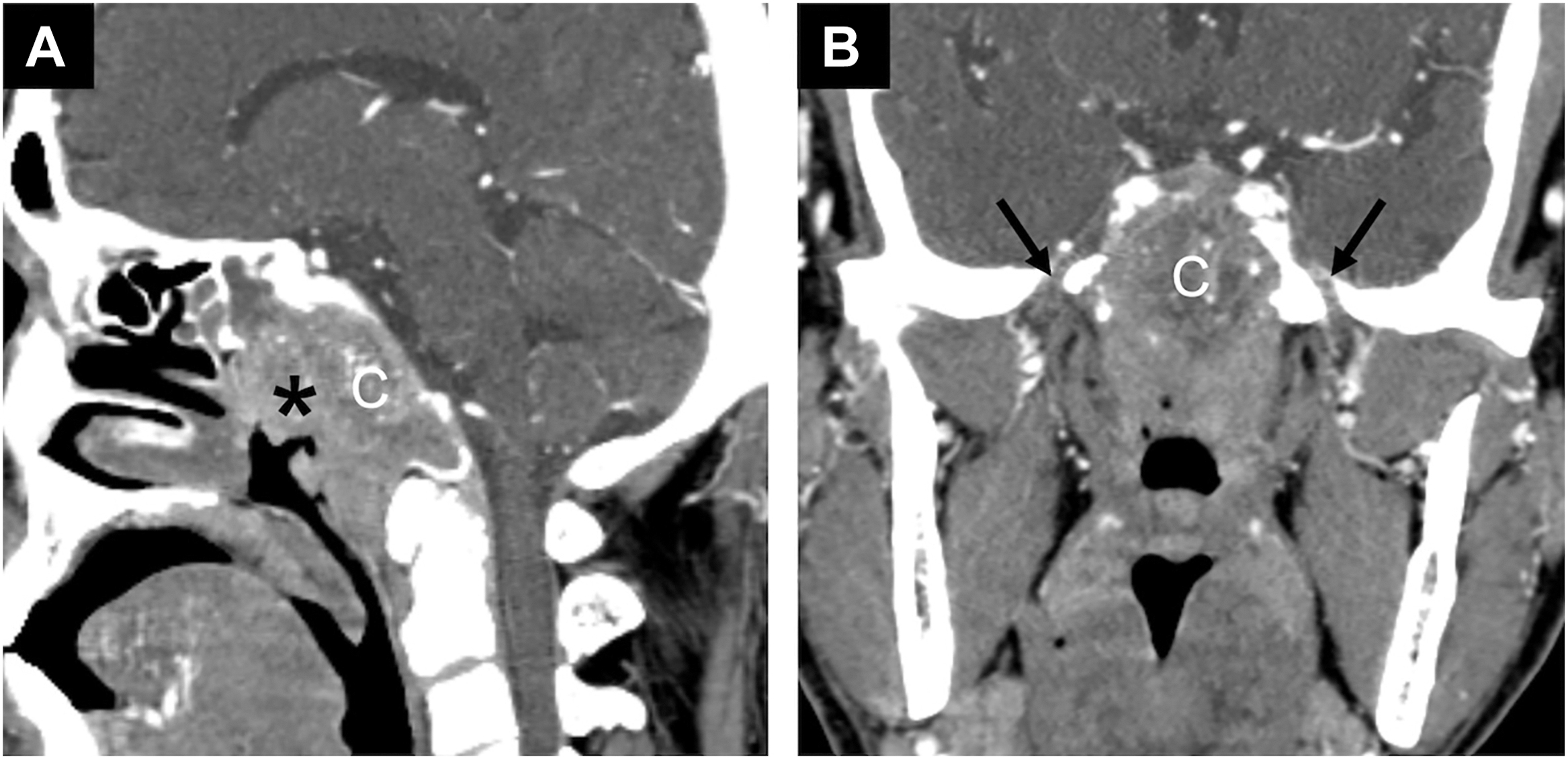 A contrast-enhanced C T scan of the head and neck in sagittal and coronal views demonstrating a mass labeled C and adjacent structures with arrows and an asterisk indicating areas of interest.