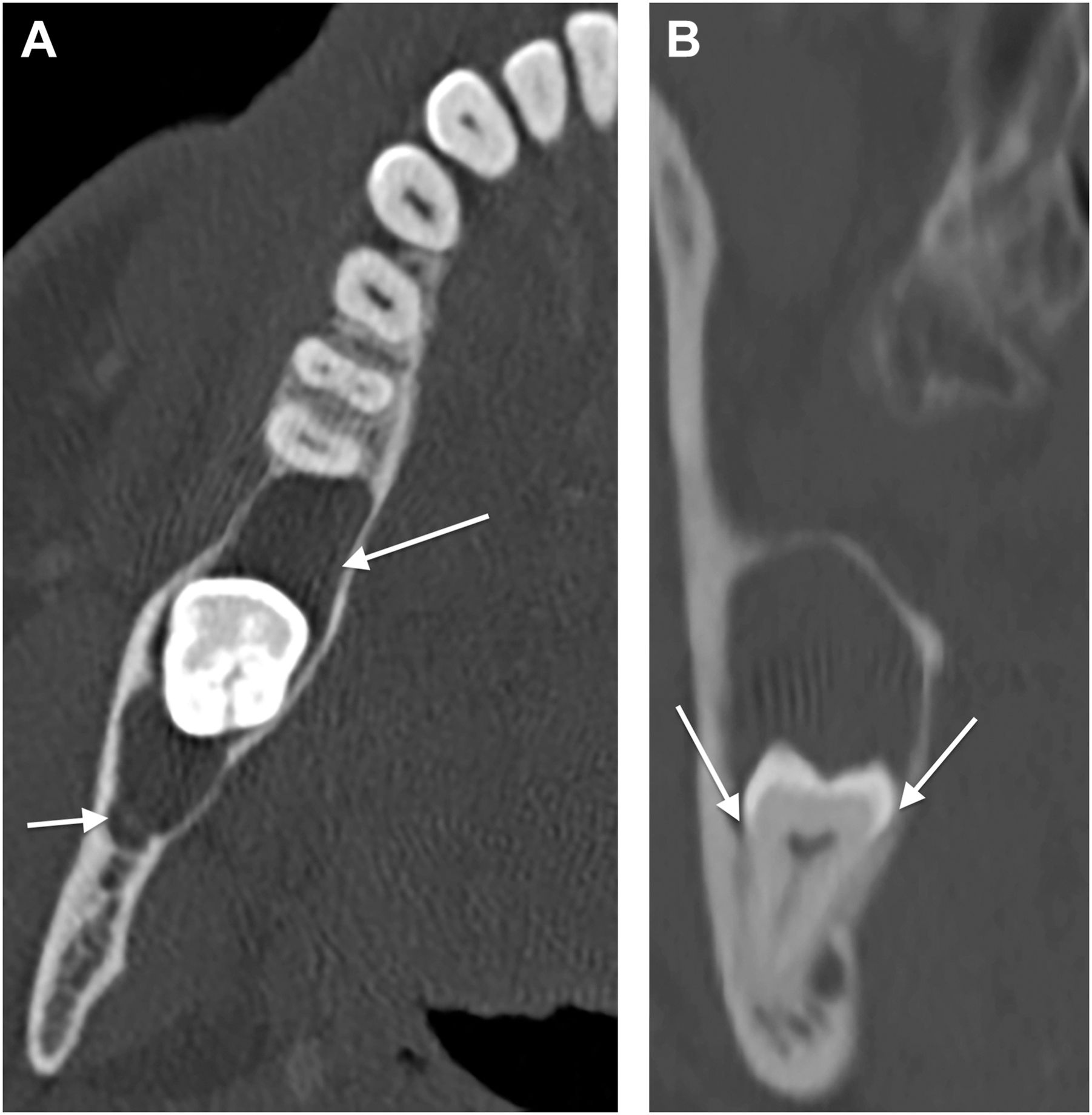 Two axial bone Computed Tomography views capturing a unilocular expansile lesion involving the mandibular third molar.
