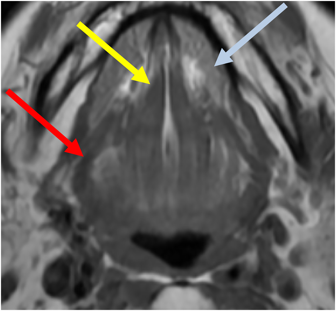 An axial T 1 M R I scan depicts the genioglossus muscle, hyoglossus muscle, and sublingual gland.