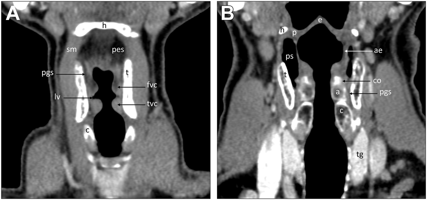 A pair of labeled C T scan sections presents anatomical structures in the head and neck, with abbreviations marking features such as h, s m, p e s, p g s, l v, t, t v c, c, and others.