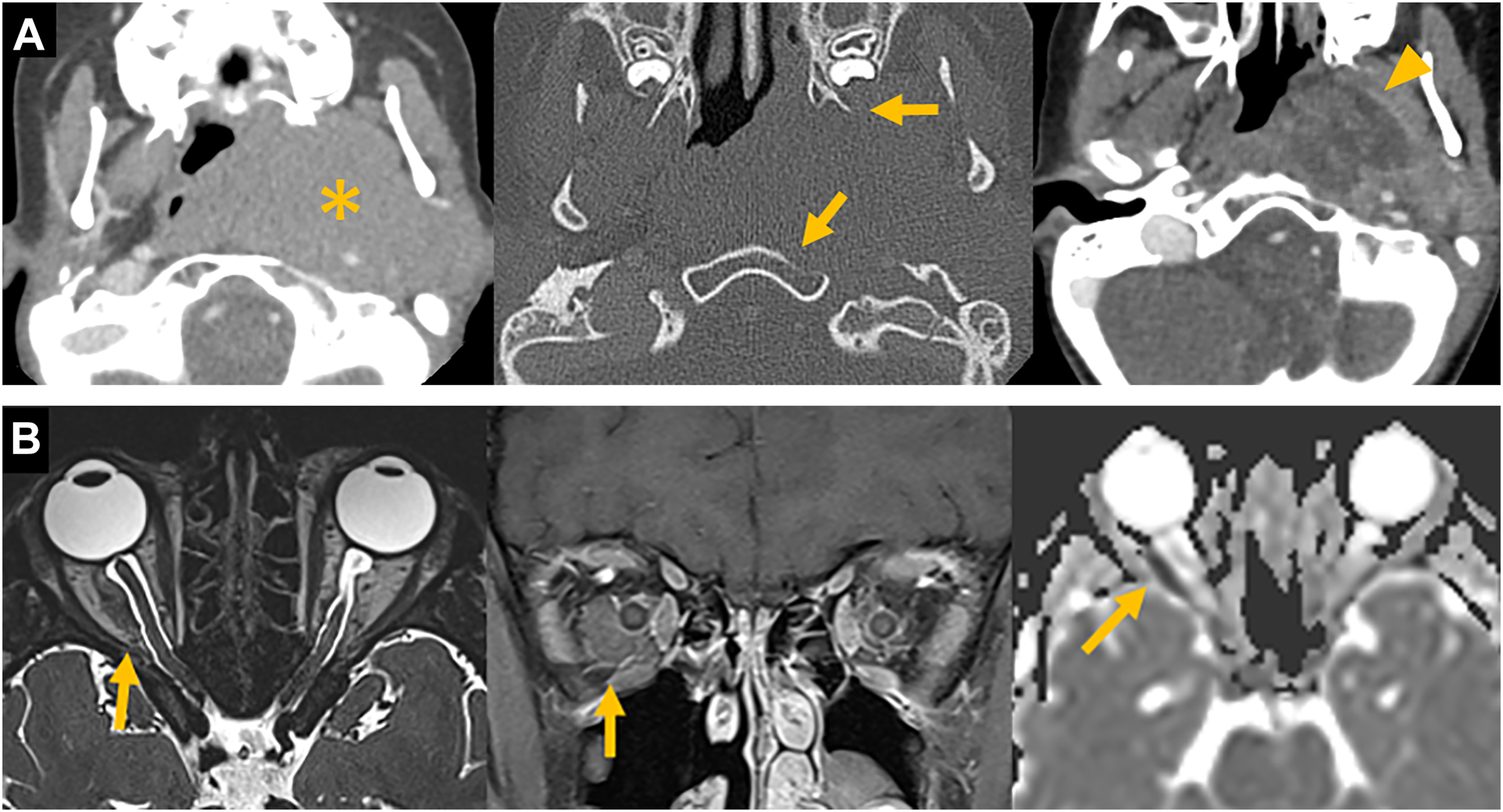 A set of six diagnostic scans in axial and coronal views highlights the abnormalities using arrows and an asterisk across facial and orbital regions.