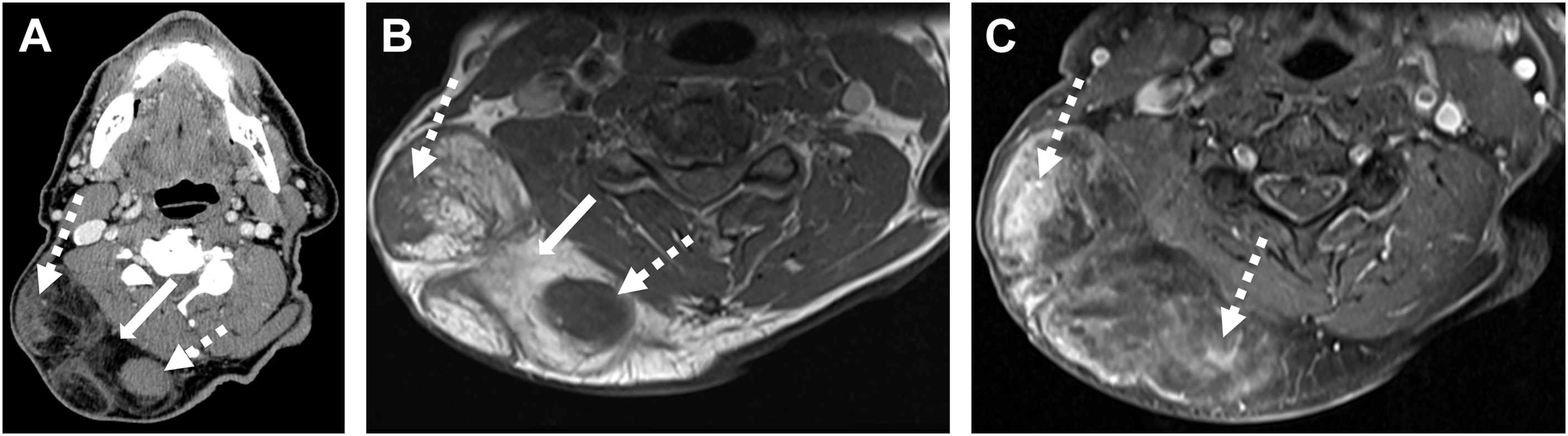 Three radiological scans depict increasing soft tissue components, septations, nodules, and a mass in the right posterior neck, as shown by arrows in the axial C T and M R I scans.