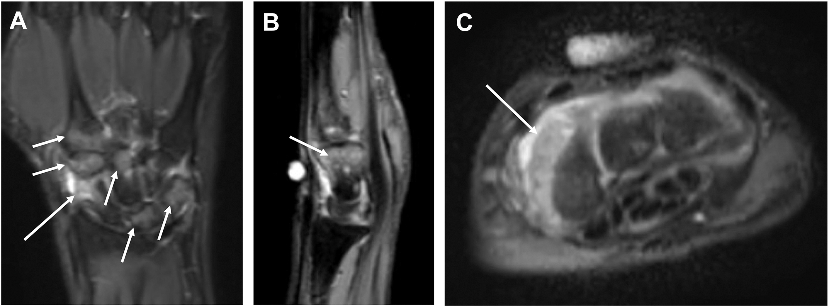 A set of three M R I scans, A, B, and C, shows rheumatoid arthritis in a wrist. Arrows in the coronal, sagittal, and axial views mark marrow edema and synovial enhancement.