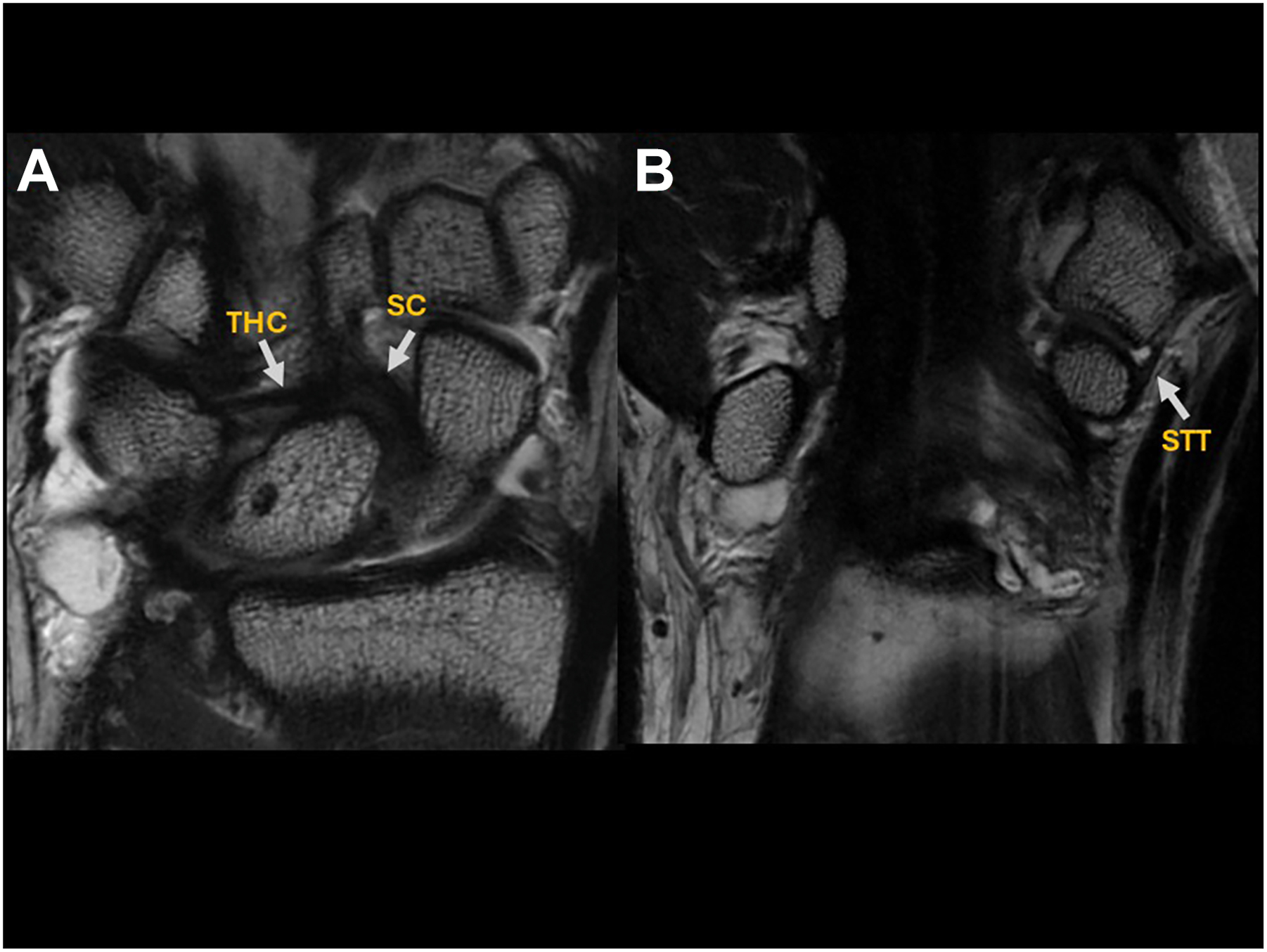 Two M R I scans of the wrist show the intrinsic midcarpal ligament that highlights the triquetrohamatecapitate and scaphotrapeziotrapezoid ligaments.