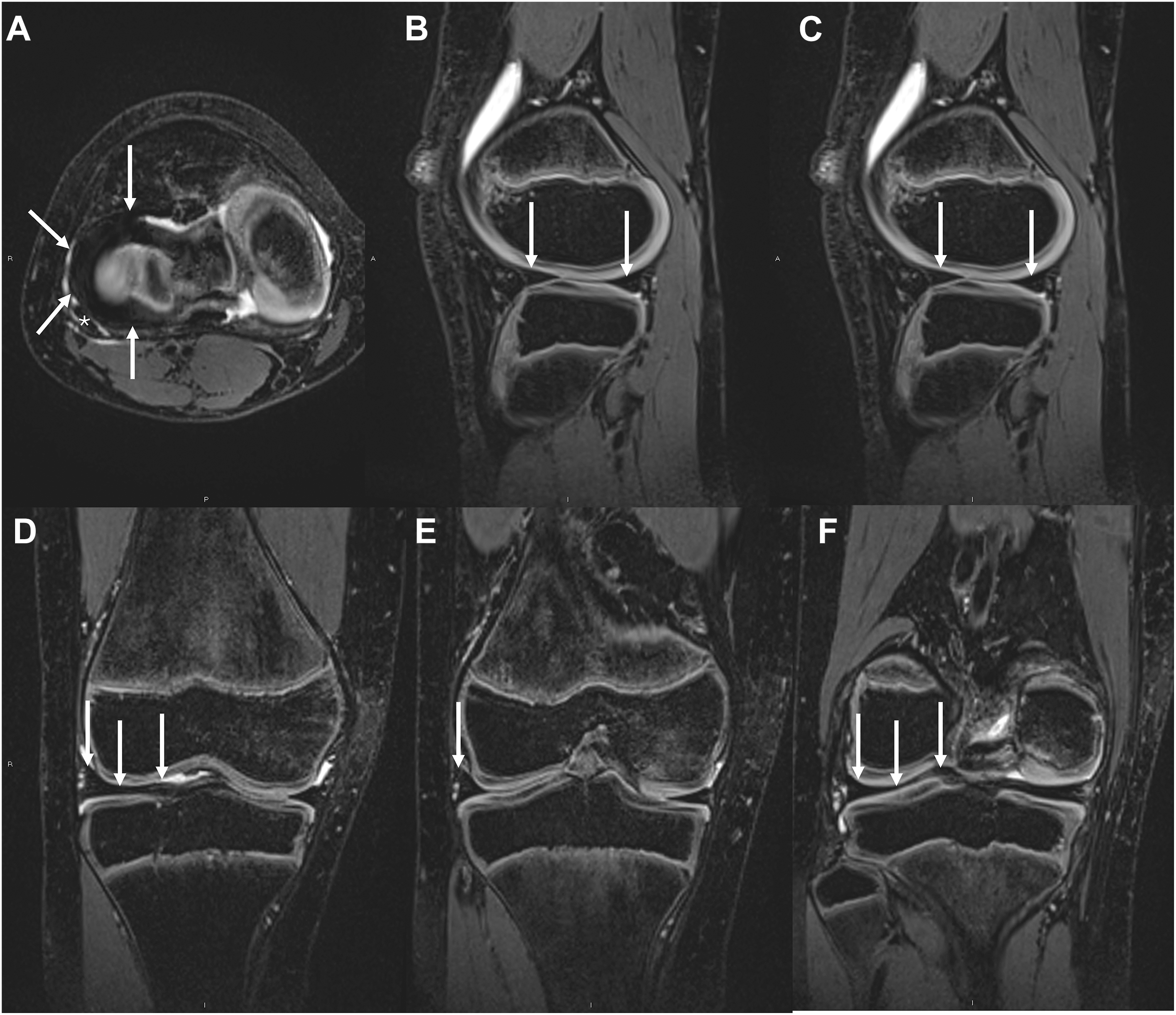 A six-panel, 3 D M R I of a knee shows a normal lateral meniscus. A few arrows in the axial, sagittal, and coronal views point to the normal structure.