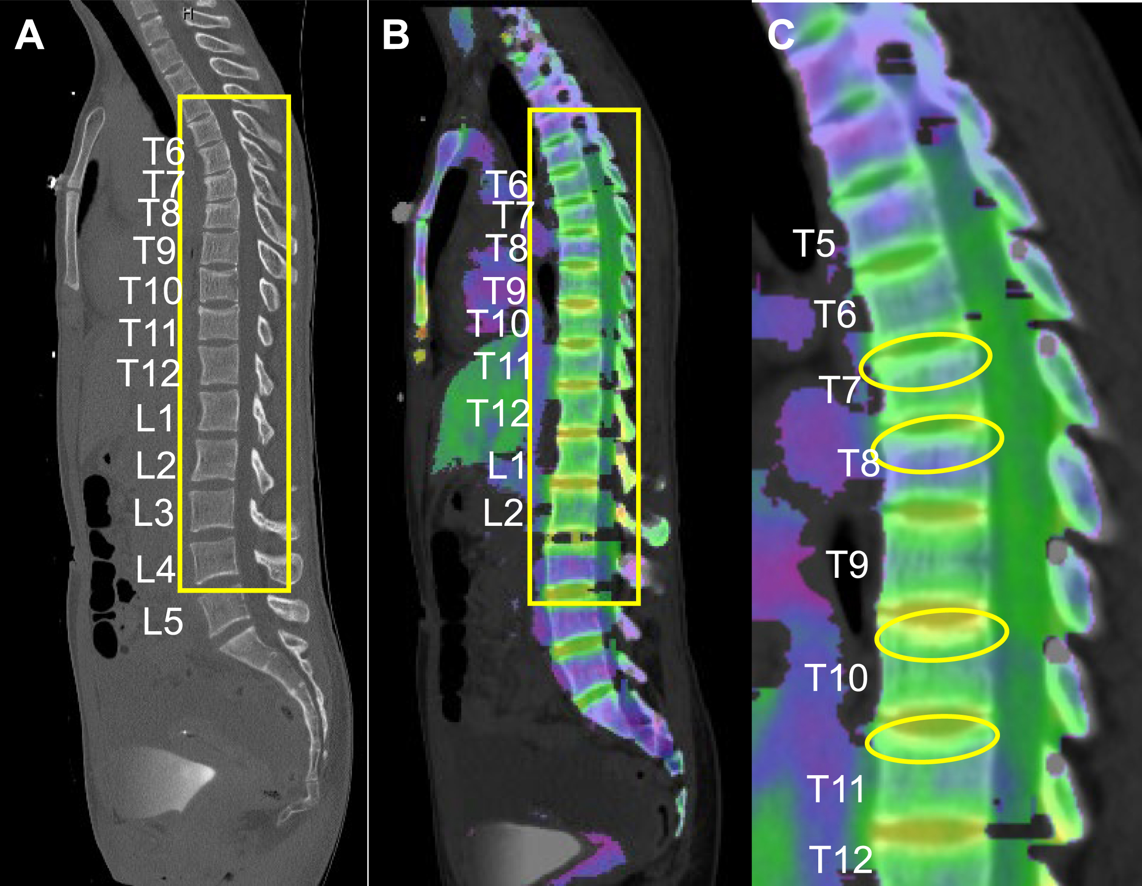 Three sagittal spine images labeled A, B, and C, showing multiple vertebral body acute compression fractures.