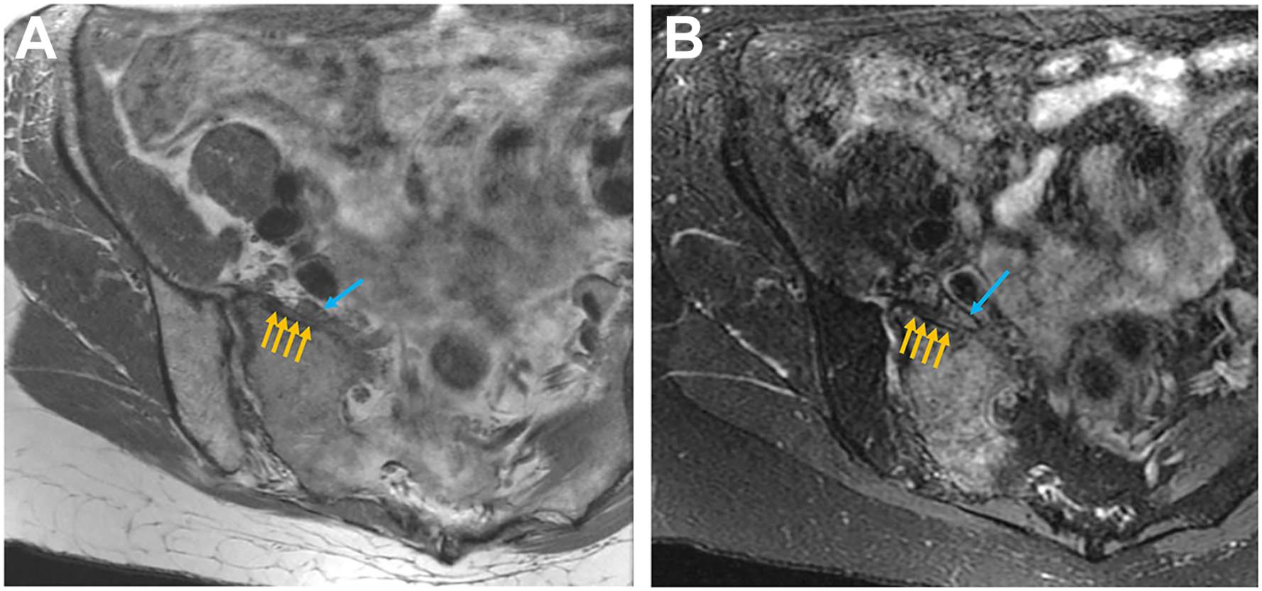 A two-panel M R I scan, A and B shows a fracture of the right hemisacrum, with new bone formation impinging on the right L five nerve root.