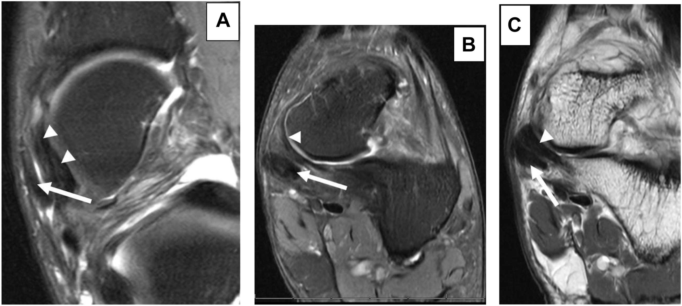 A set of three M R I scans, A, B, and C, shows P T T tendinopathy. The axial and coronal views use arrows and arrowheads to mark P T T attenuation, spring ligament thickening, and edema.