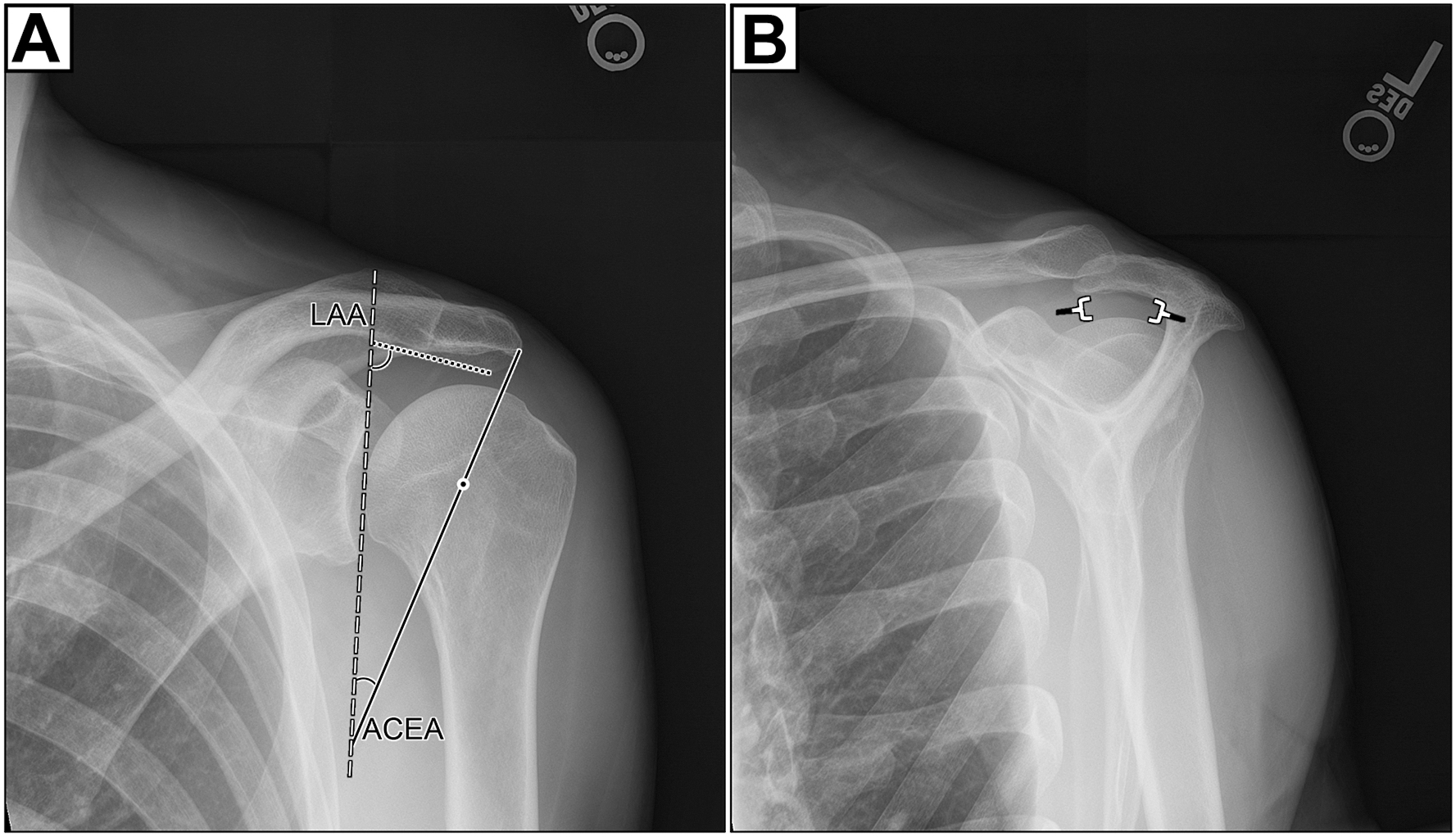A set of two panels shows two views of the left shoulder shows the lateral acromial angle L A A and an outlet view, shows a curved, or Type two, acromion with identification of the subacromial space.