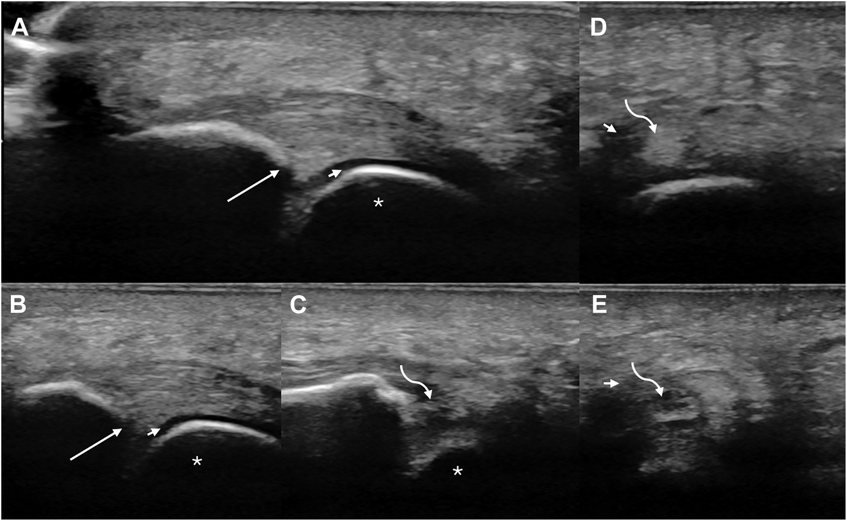 A five-panel ultrasound scan, A through E, shows a plantar plate tear, detailing normal central and medial insertions but partial discontinuity in the lateral insertion and distally.