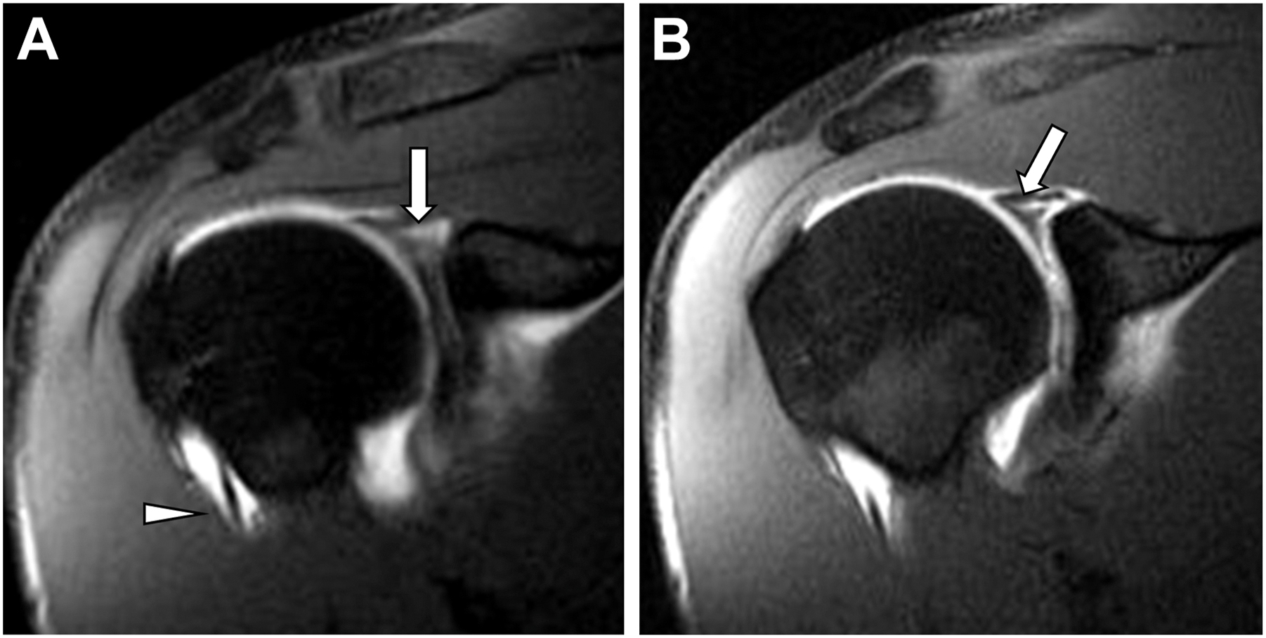Two coronal shoulder scans show irregularity along the upper joint rim with fluid tracking into the tendon recess, indicating labral damage.