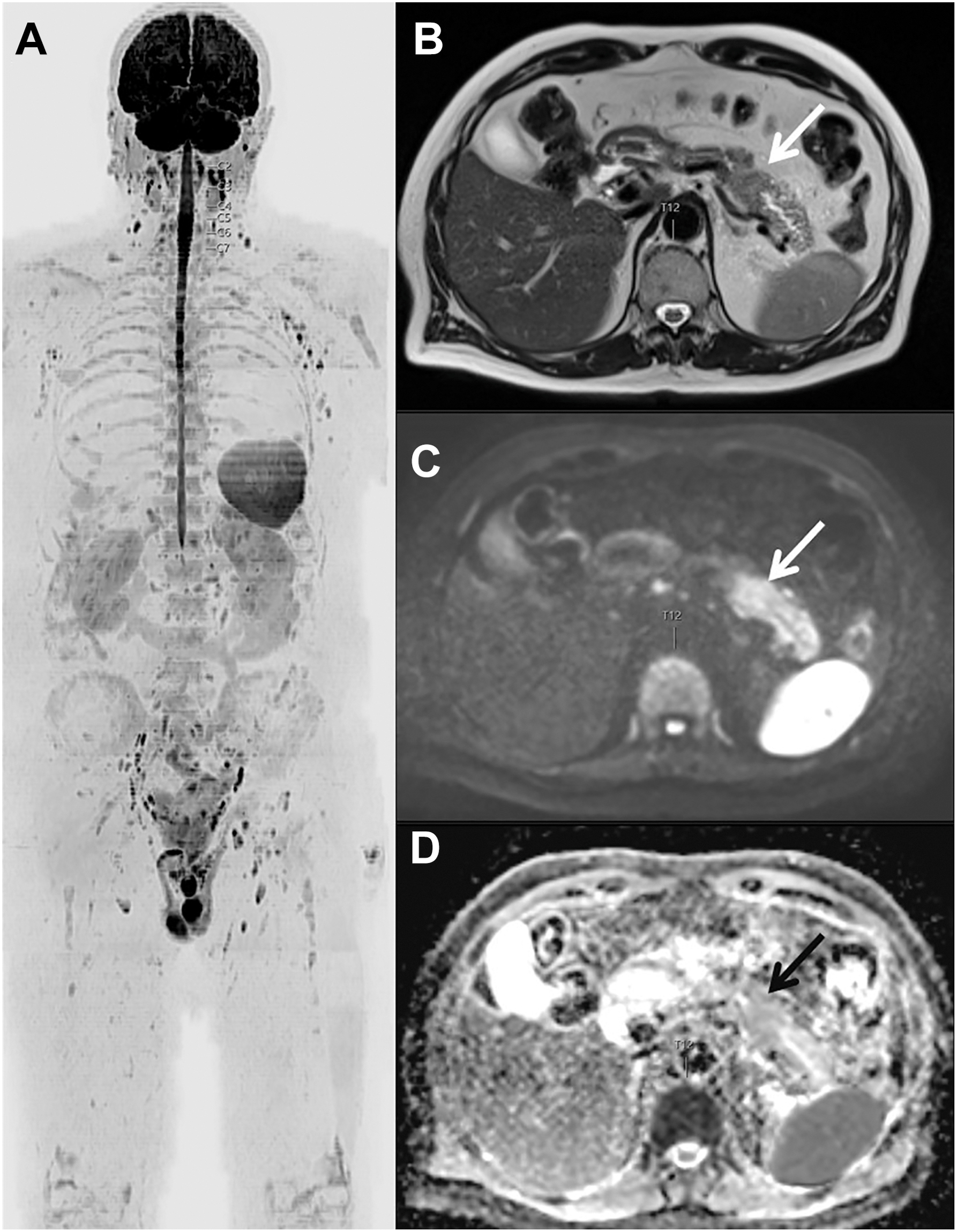 Four-panel medical imaging study of a 77-year-old male shows a 2.5-centimeter mass obstructing the pancreatic duct, categorized as O N C O-R A D S 4 and requiring urgent hepatobiliary referral.