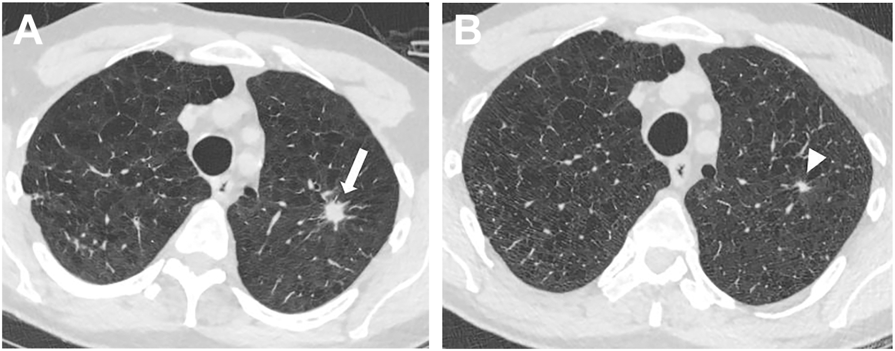 A two-panel C T chest scan of a 62-year-old smoker shows a left upper lobe lung nodule that grew from 0.7 centimeters to a 1.6 centimeter spiculated mass over four years.