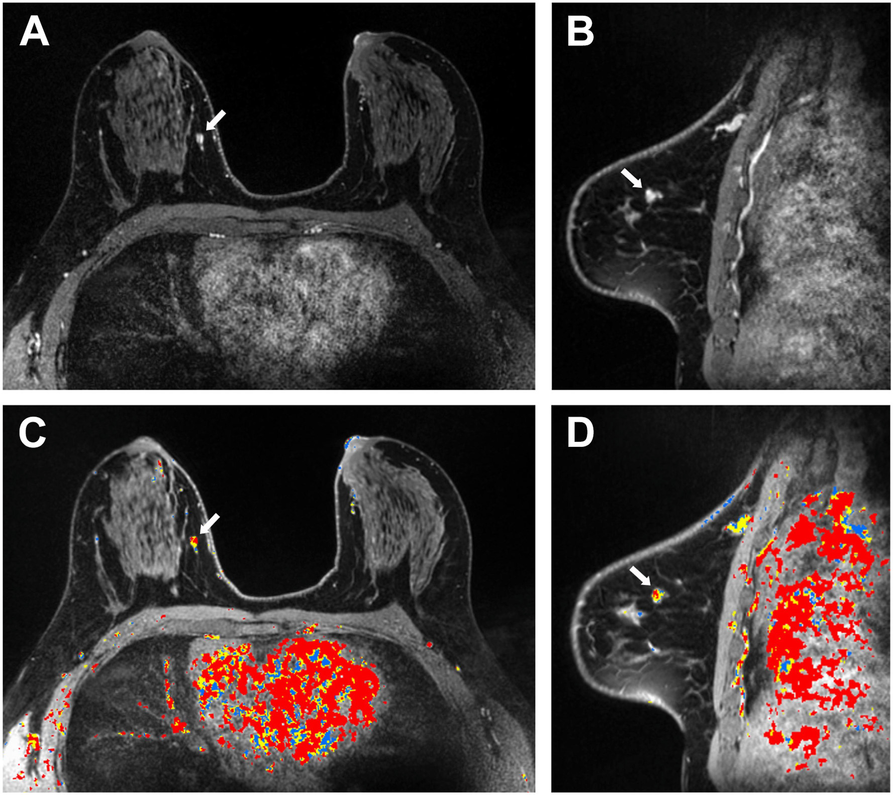 Four panels with breast M R I shows a 6-millimeter enhancing mass in the right breast with mixed delayed kinetics, and verified as invasive ductal carcinoma.