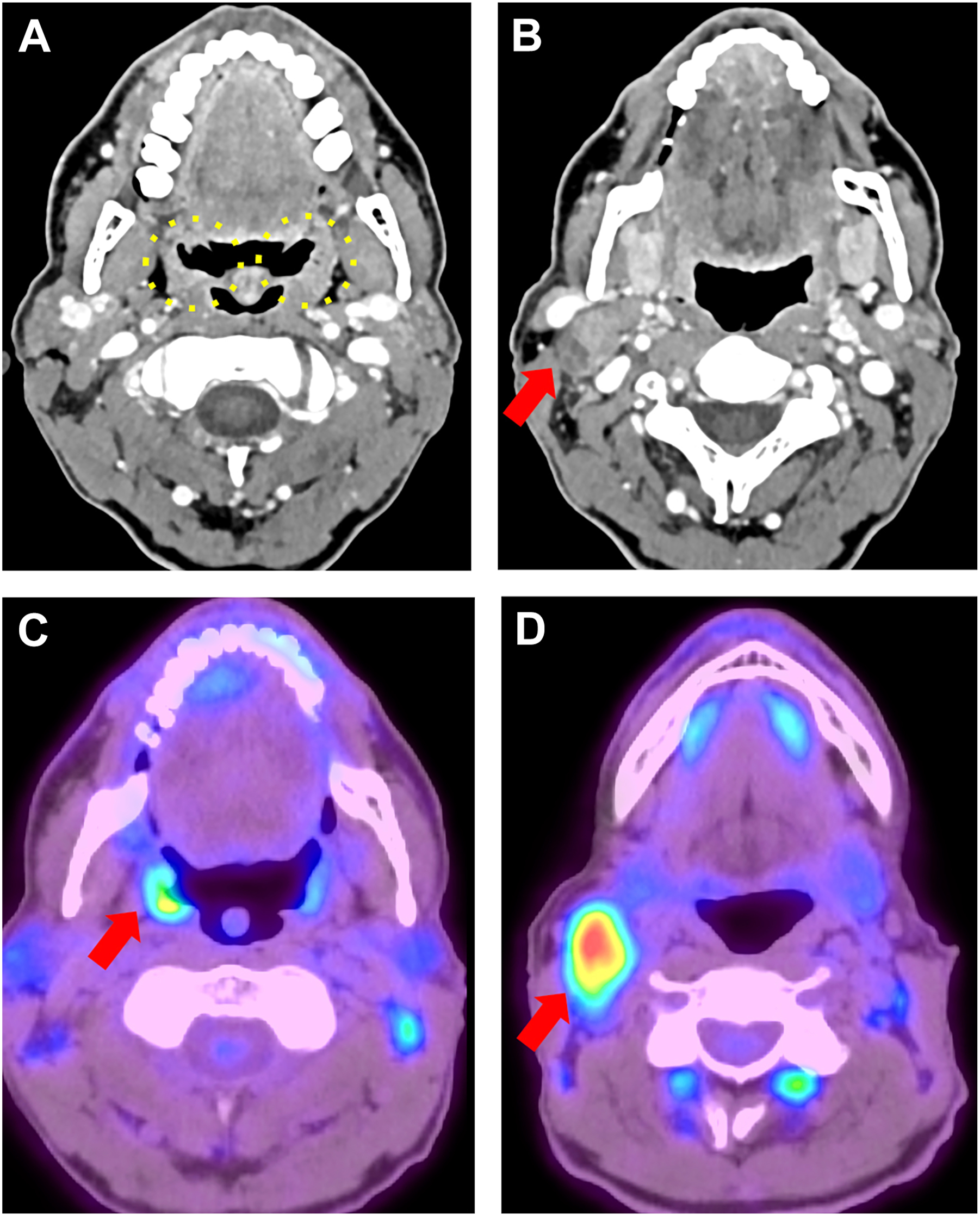 Four diagnostic scans of the neck region labeled A to D, combining Computed Tomography and positron emission tomography imaging.