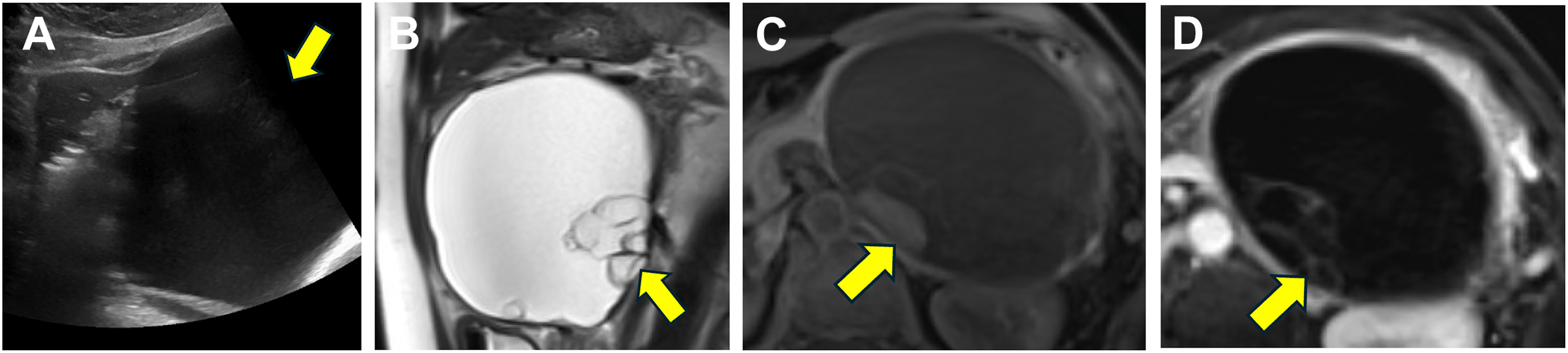 Four panels including one ultrasound image and three abdominal MRI images of a 51-year-old female patient with pancreatic tail mucinous cystic neoplasm with focal high-grade dysplasia shows a large pancreatic tail cystic lesion with thin septations and internal debris, without solid enhancing mass.