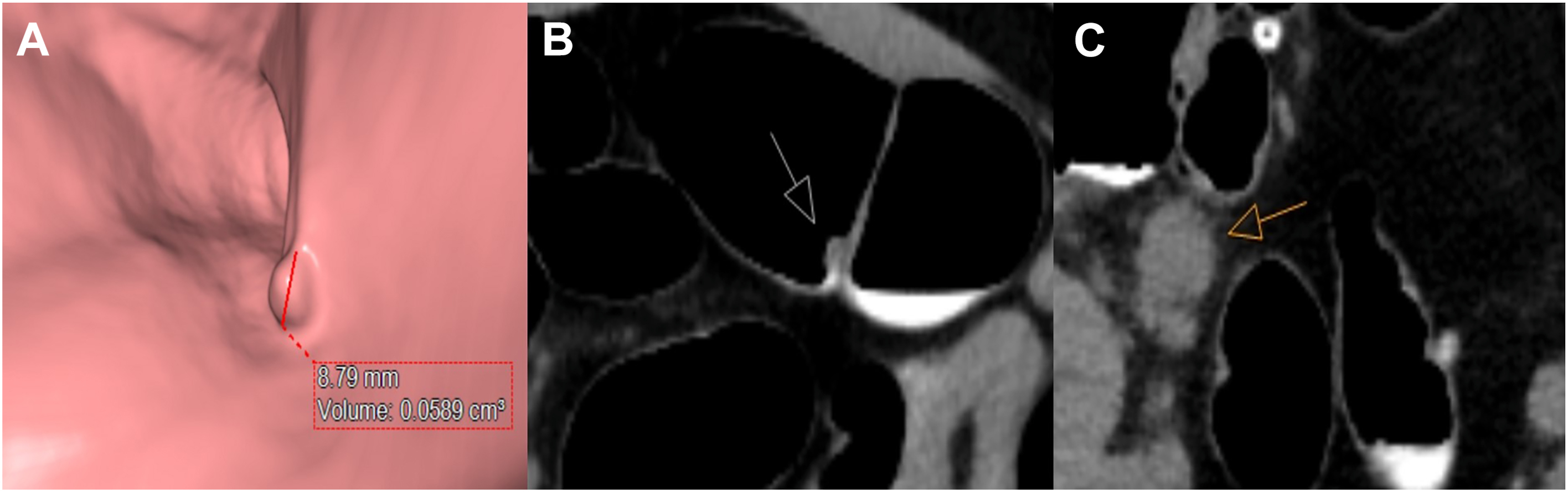 Three panels show a colorectal polyp and an incidental mesenteric lymph node in a 76-year-old male, as captured through 3 D and 2 D computed tomography colonography.