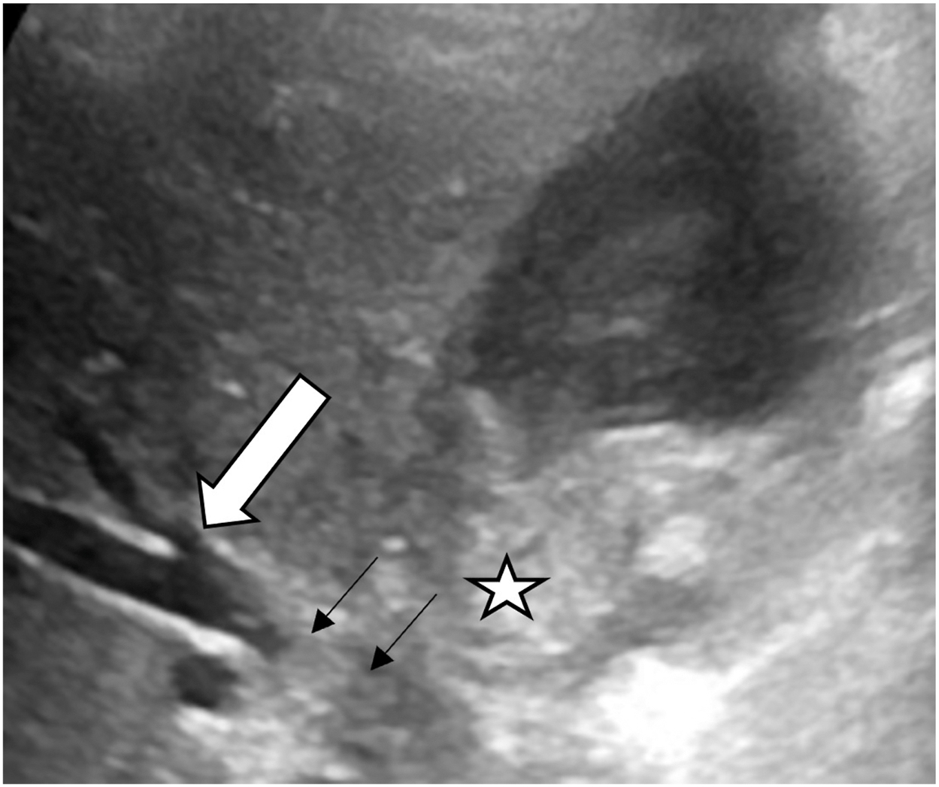 A grayscale axial ultrasound shows malignant mural thickening at the gallbladder neck, forming a cervix-like appearance with adjacent liver infiltration and biliary obstruction indicated by arrows.